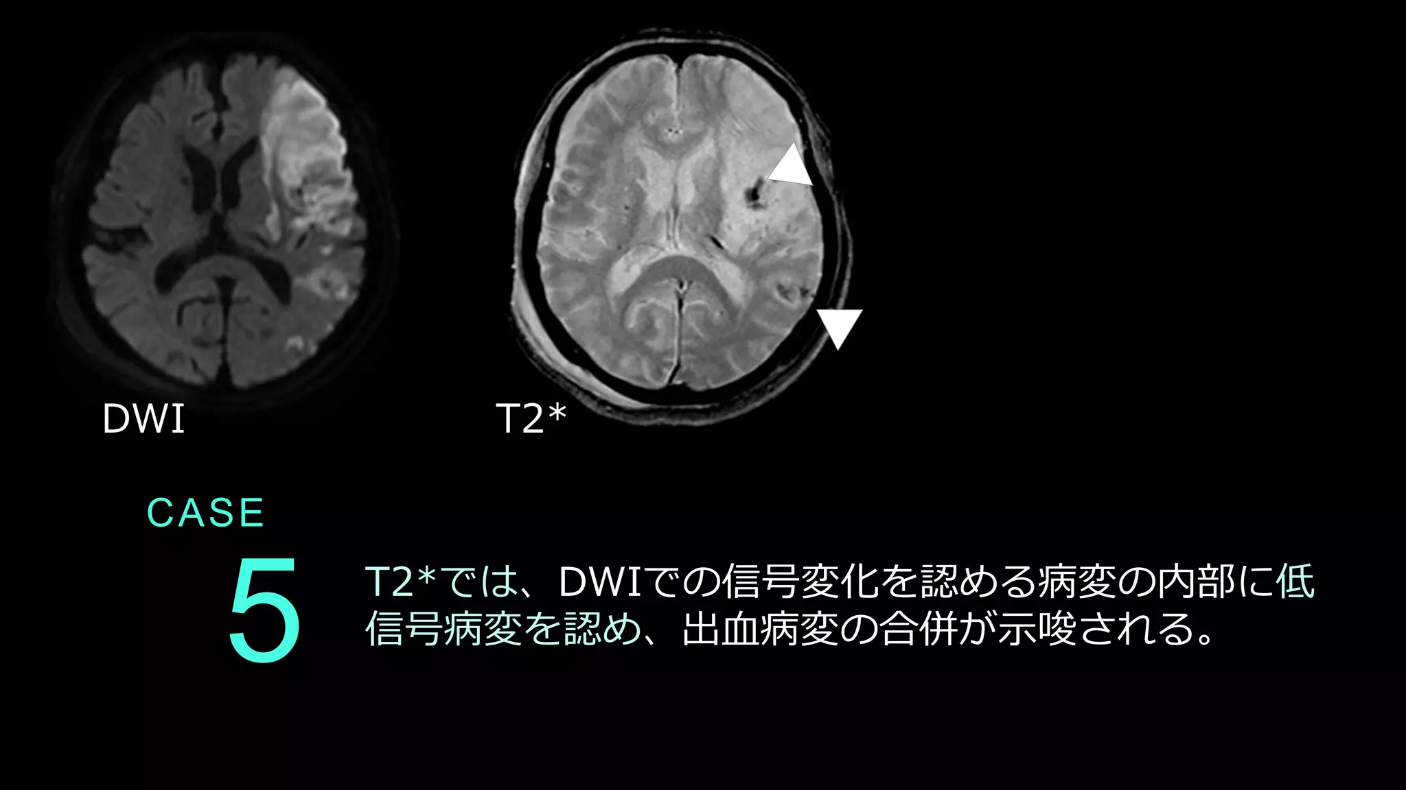 CASE
5 T2*では、DWIでの信号変化を認める病変の内部に低
信号病変を認め、出血病変の合併が示唆される。
DWI T2*
 