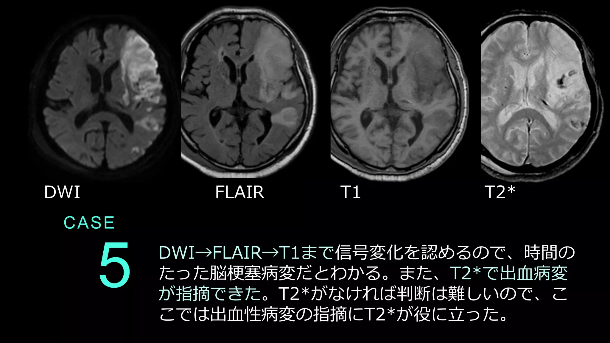 CASE
5 DWI→FLAIR→T1まで信号変化を認めるので、時間の
たった脳梗塞病変だとわかる。また、T2*で出血病変
が指摘できた。T2*がなければ判断は難しいので、こ
こでは出血性病変の指摘にT2*が役に立った。
DWI FLAIR T1 T2*
 