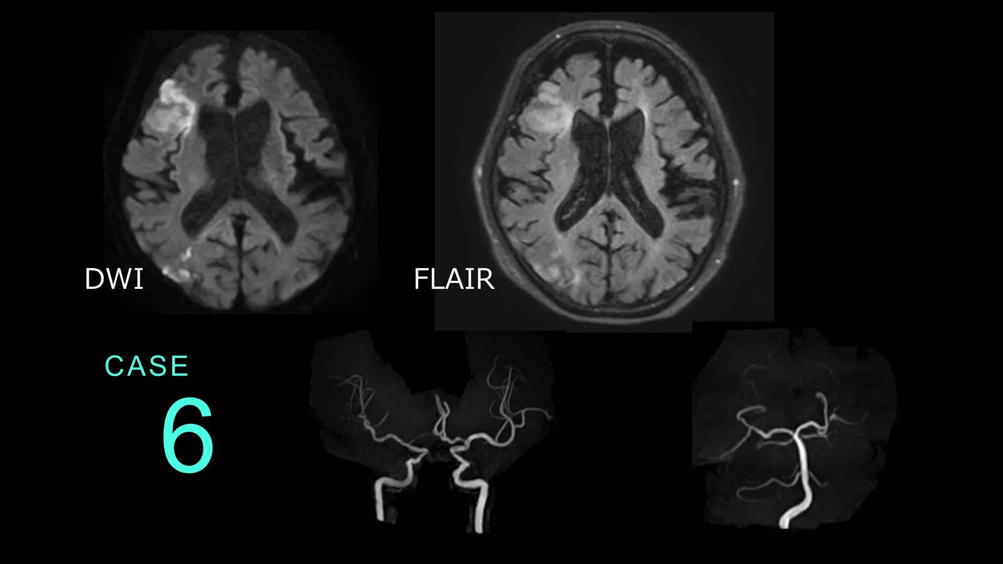 CASE
6
DWI FLAIR
 