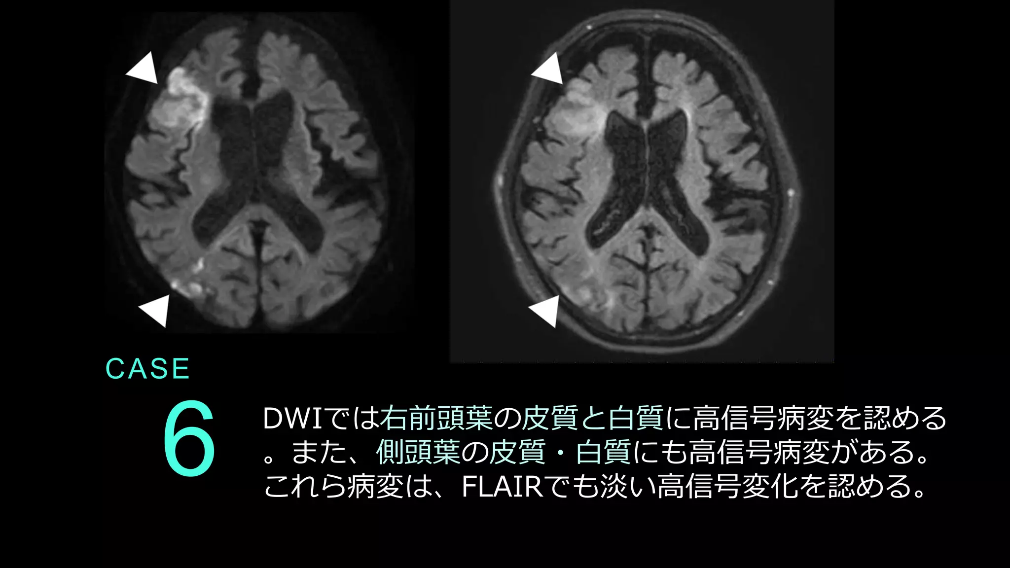 CASE
6 DWIでは右前頭葉の皮質と白質に高信号病変を認める
。また、側頭葉の皮質・白質にも高信号病変がある。
これら病変は、FLAIRでも淡い高信号変化を認める。
 