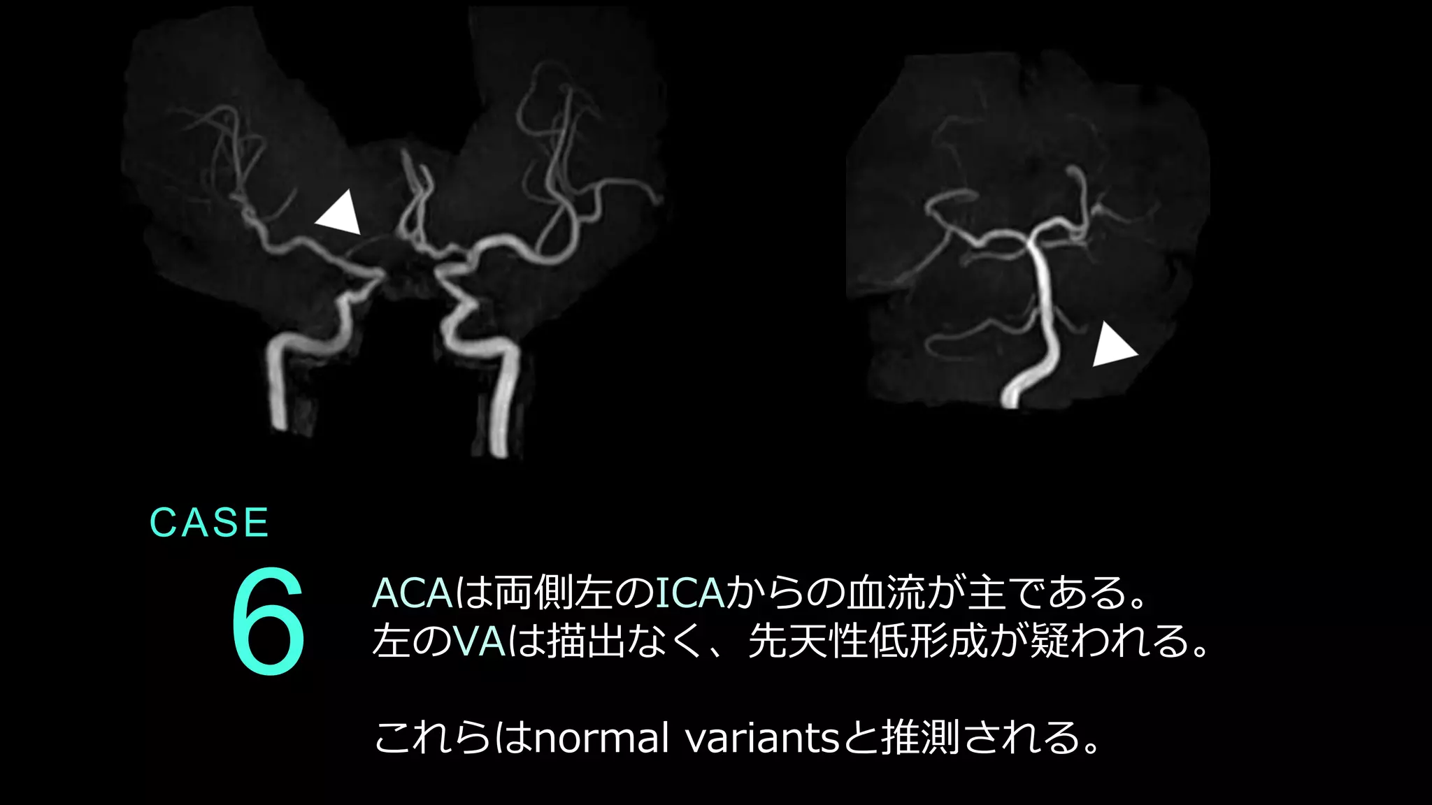 CASE
6 ACAは両側左のICAからの血流が主である。
左のVAは描出なく、先天性低形成が疑われる。
これらはnormal variantsと推測される。
 
