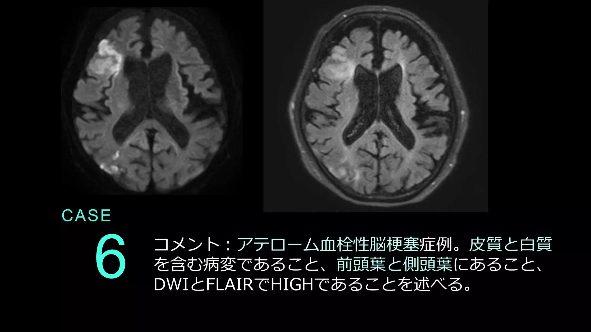 CASE
6 コメント：アテローム血栓性脳梗塞症例。皮質と白質
を含む病変であること、前頭葉と側頭葉にあること、
DWIとFLAIRでHIGHであることを述べる。
 