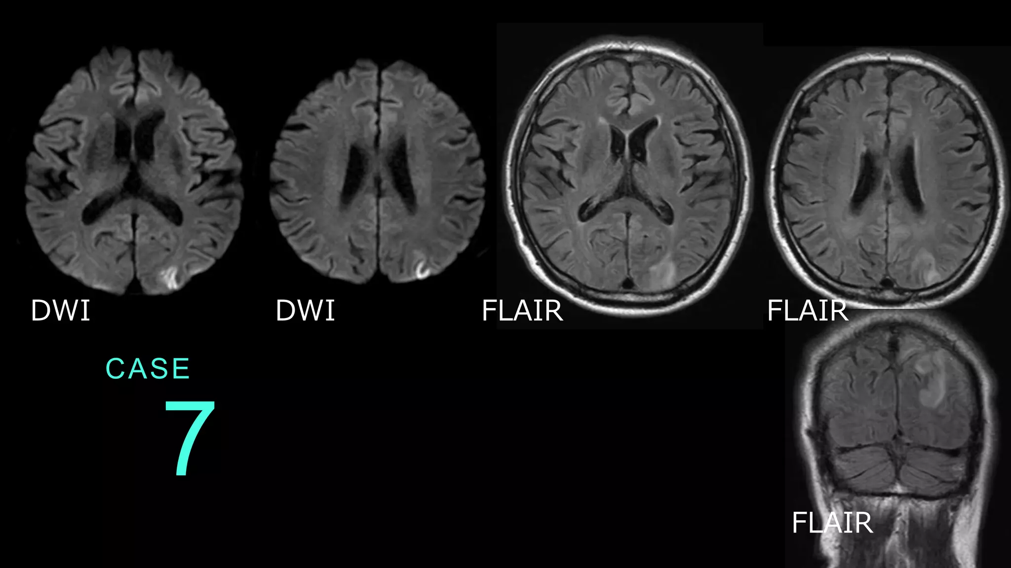 CASE
7
DWI DWI FLAIR FLAIR
FLAIR
 