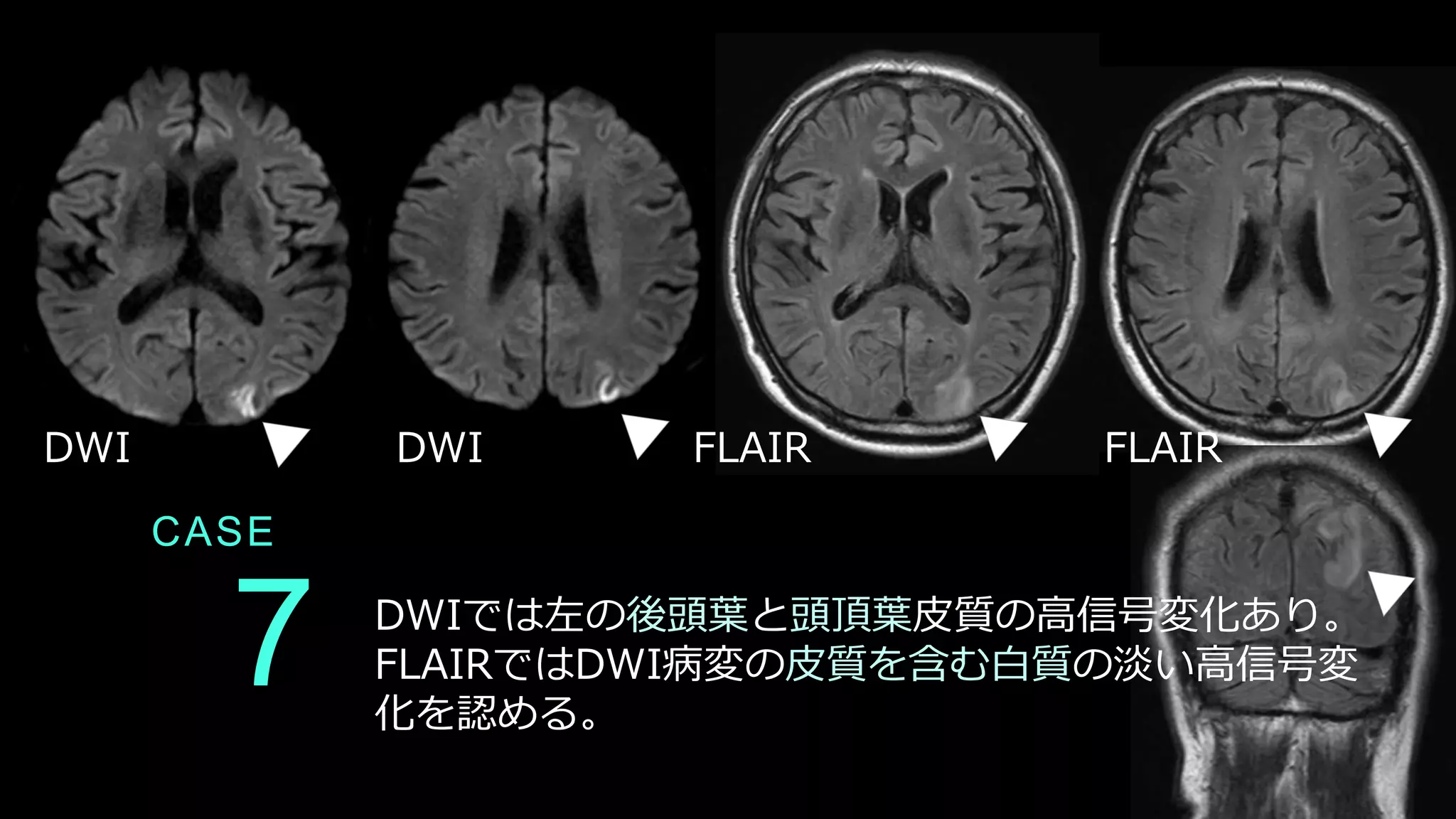 CASE
7 DWIでは左の後頭葉と頭頂葉皮質の高信号変化あり。
FLAIRではDWI病変の皮質を含む白質の淡い高信号変
化を認める。
DWI DWI FLAIR FLAIR
 