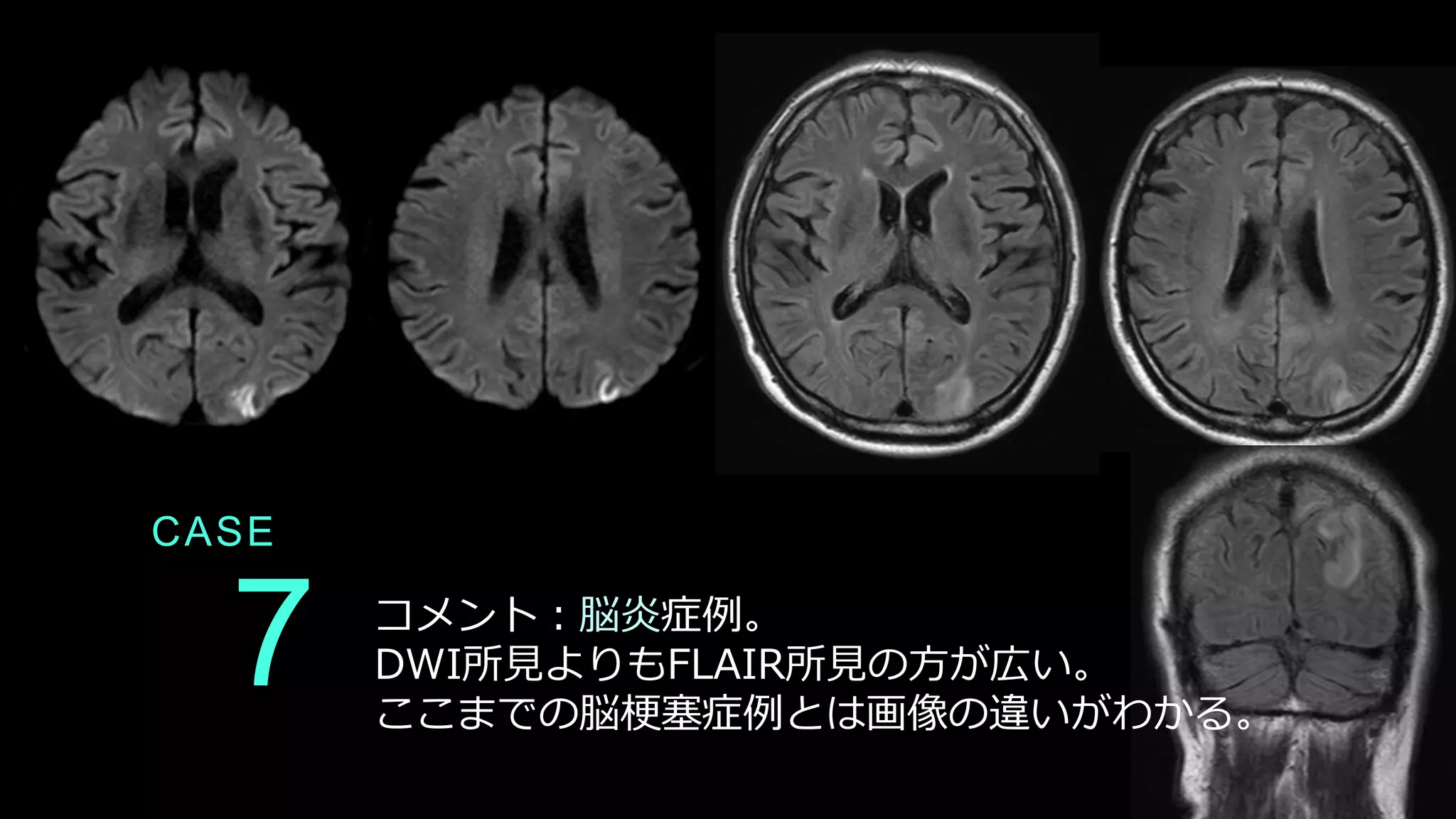 CASE
7 コメント：脳炎症例。
DWI所見よりもFLAIR所見の方が広い。
ここまでの脳梗塞症例とは画像の違いがわかる。
 