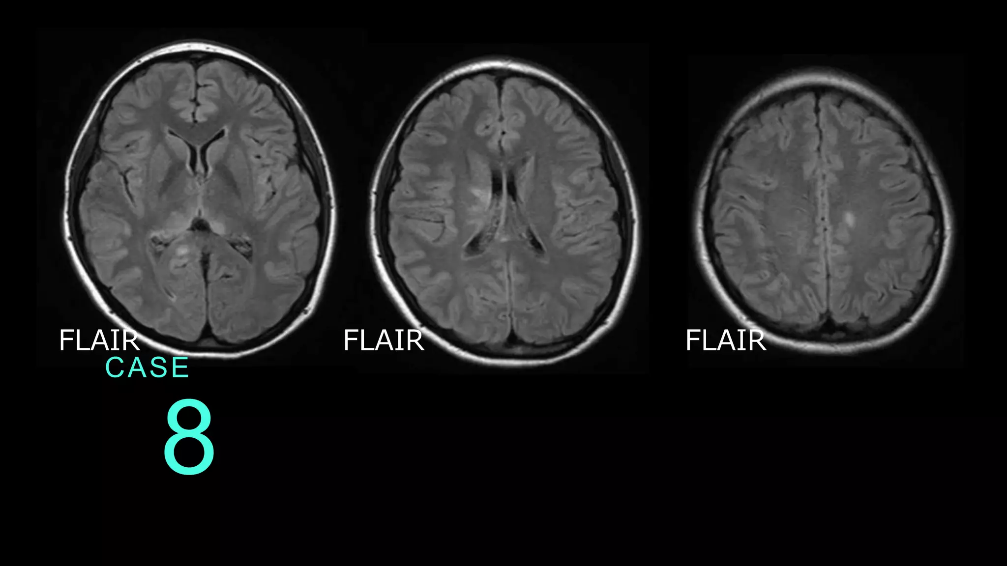 8
CASE
FLAIR FLAIR FLAIR
 