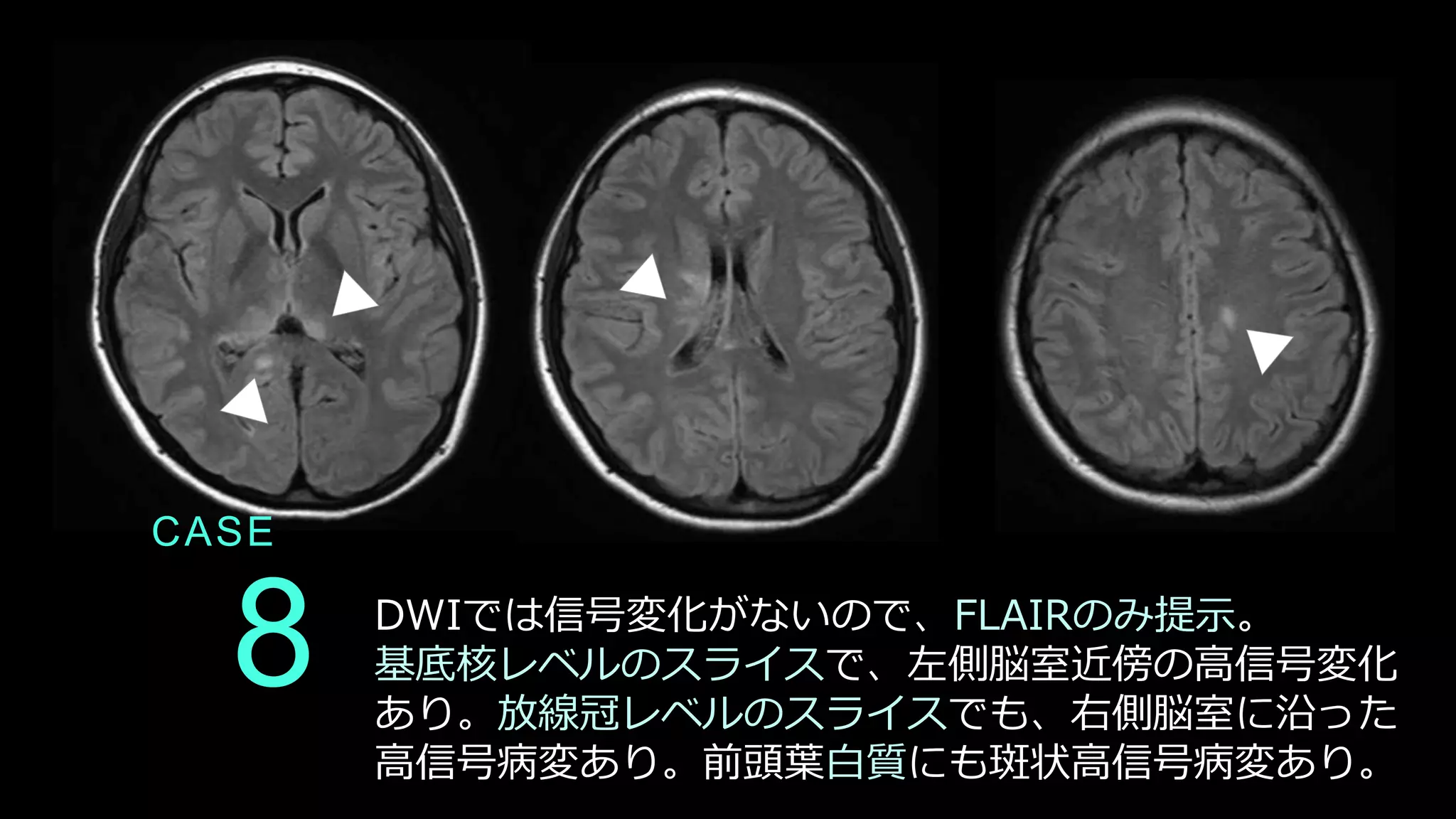 8
CASE
DWIでは信号変化がないので、FLAIRのみ提示。
基底核レベルのスライスで、左側脳室近傍の高信号変化
あり。放線冠レベルのスライスでも、右側脳室に沿った
高信号病変あり。前頭葉白質にも斑状高信号病変あり。
 