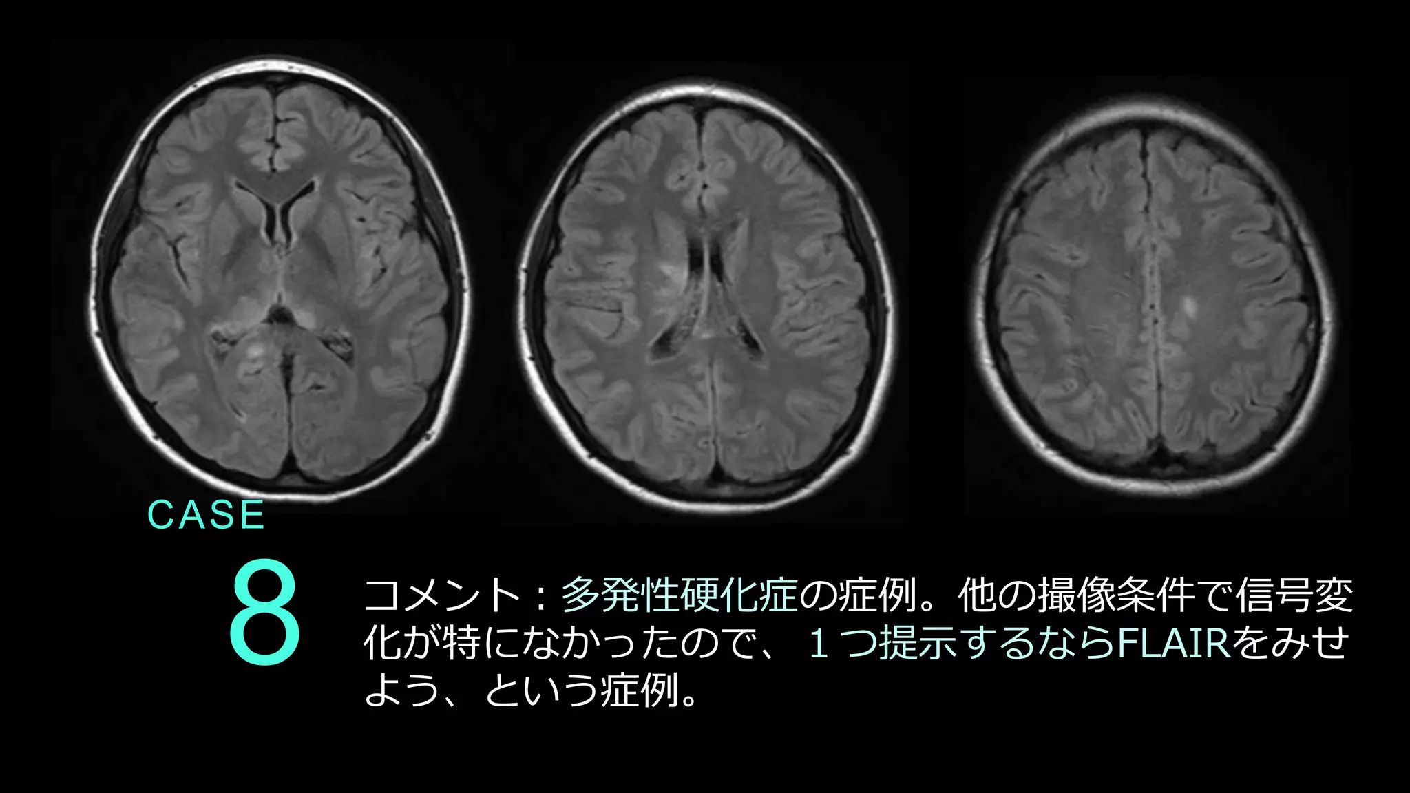 8
CASE
コメント：多発性硬化症の症例。他の撮像条件で信号変
化が特になかったので、１つ提示するならFLAIRをみせ
よう、という症例。
 