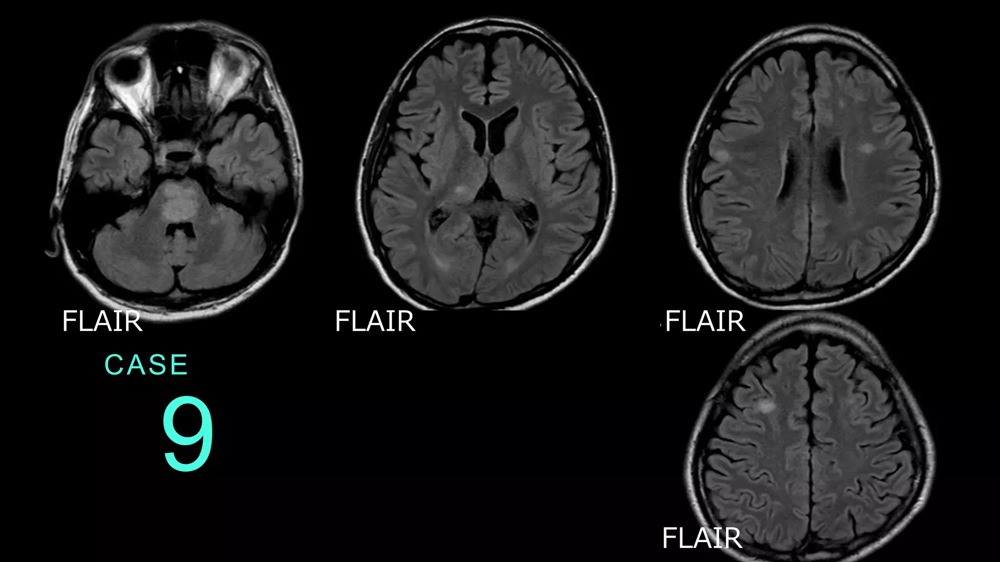 9
CASE
FLAIR FLAIR FLAIR
FLAIR
 