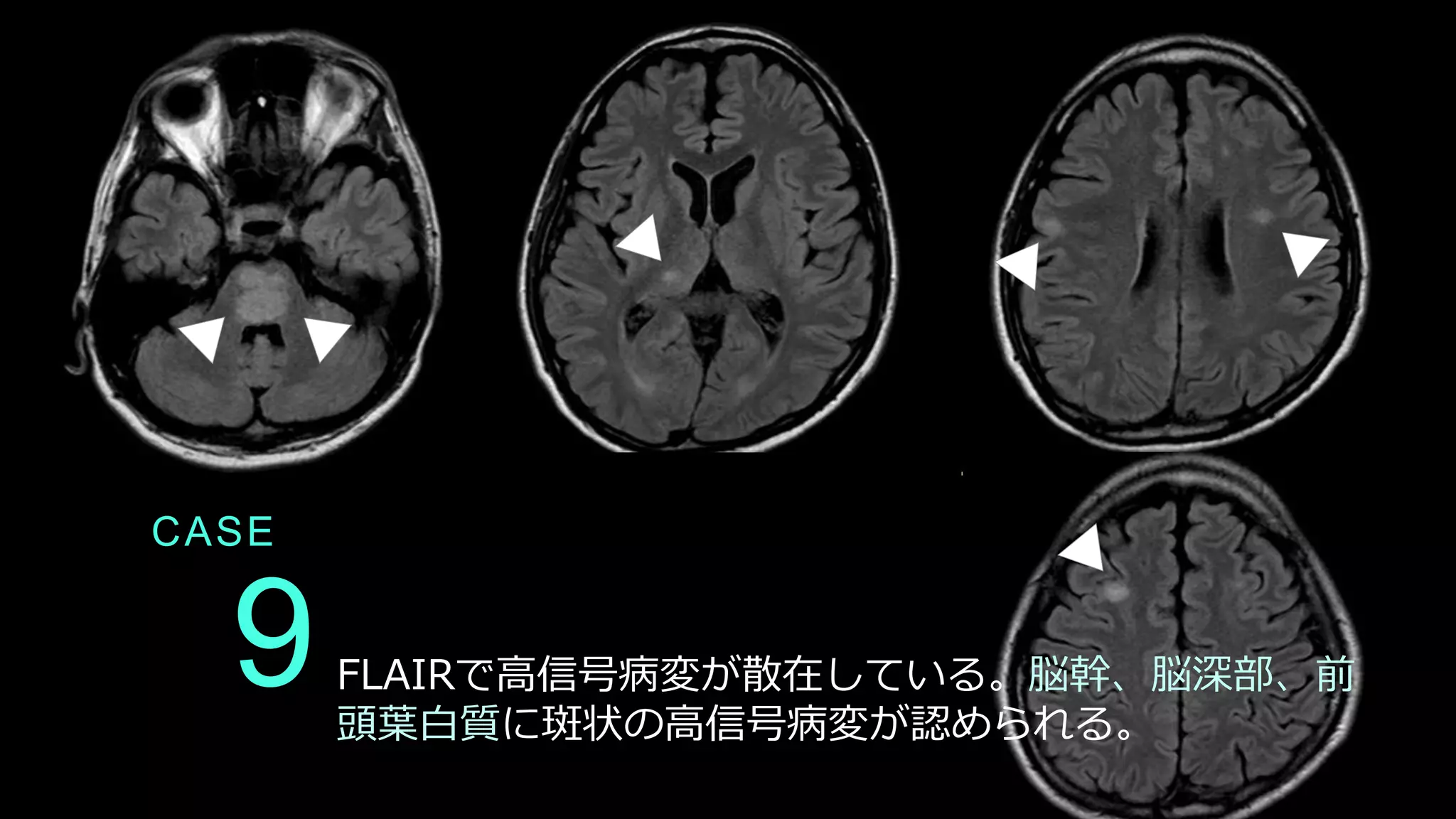 9
CASE
FLAIRで高信号病変が散在している。脳幹、脳深部、前
頭葉白質に斑状の高信号病変が認められる。
 