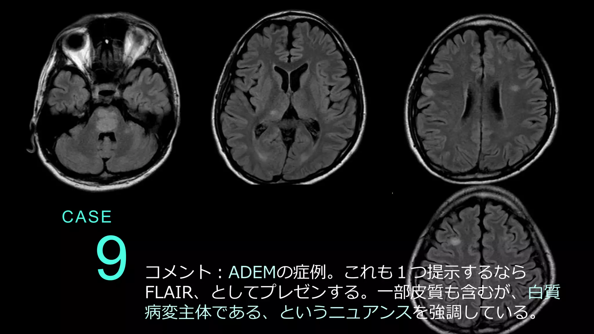9
CASE
コメント：ADEMの症例。これも１つ提示するなら
FLAIR、としてプレゼンする。一部皮質も含むが、白質
病変主体である、というニュアンスを強調している。
 