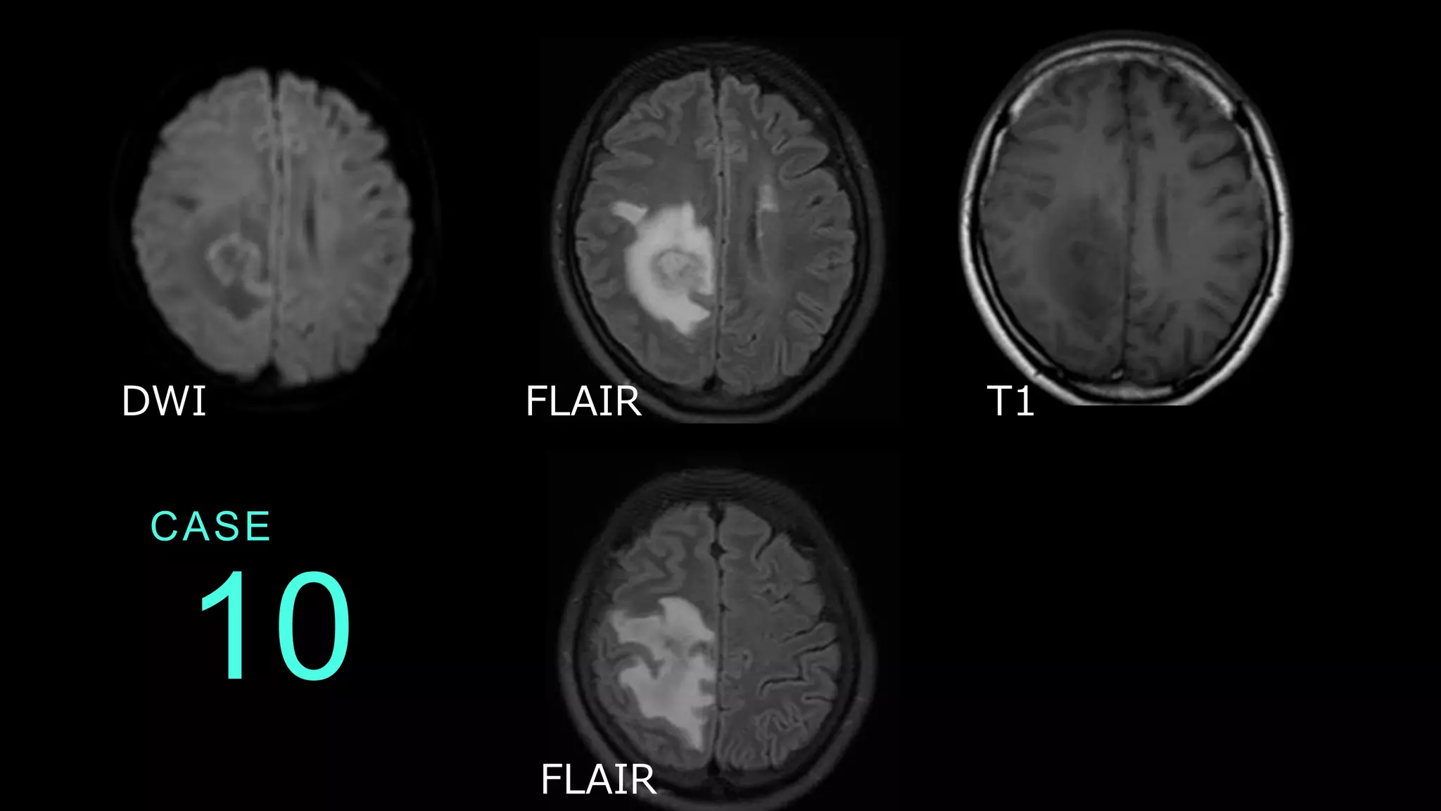 10
CASE
DWI FLAIR T1
FLAIR
 