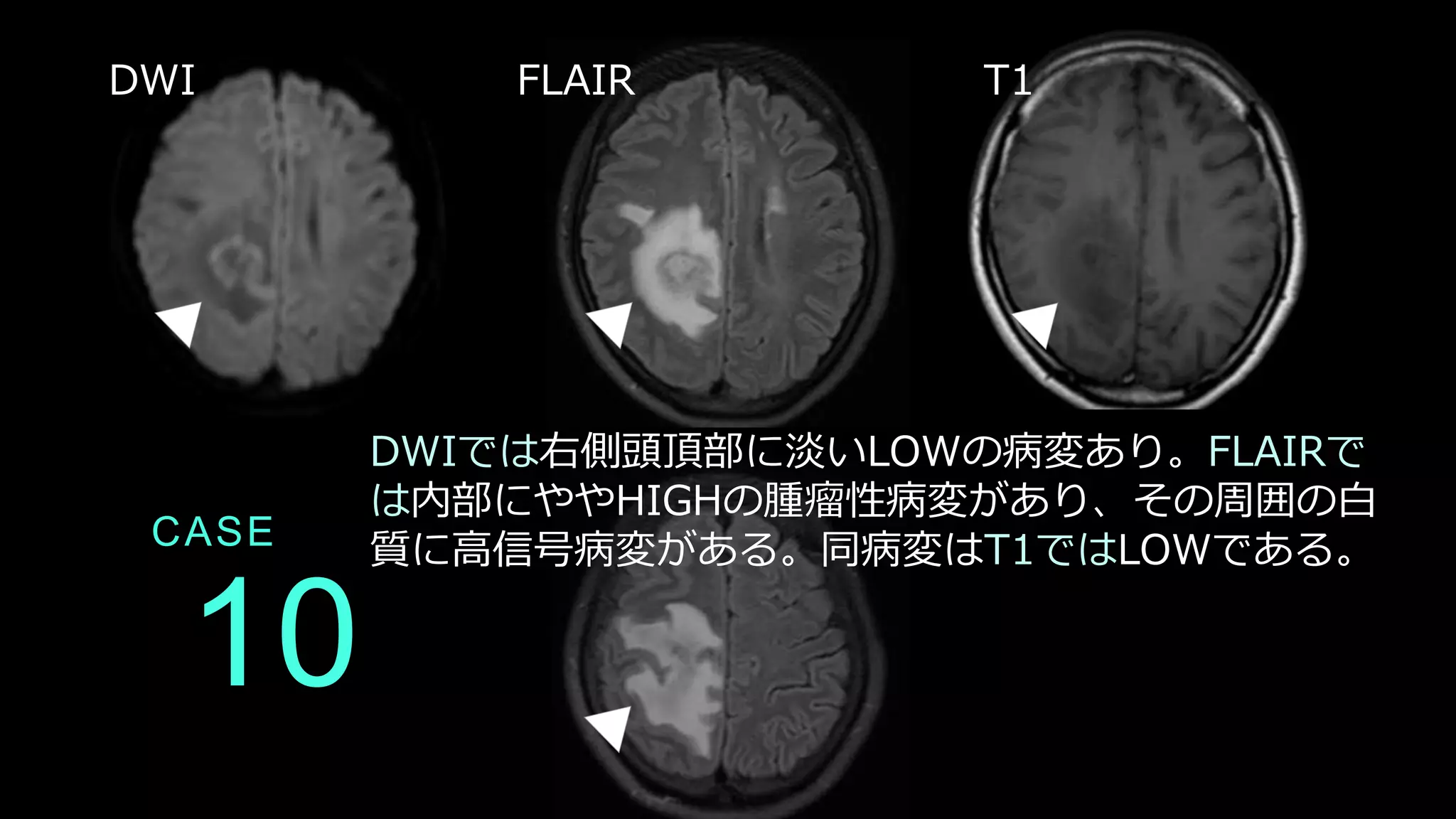10
CASE
DWIでは右側頭頂部に淡いLOWの病変あり。FLAIRで
は内部にややHIGHの腫瘤性病変があり、その周囲の白
質に高信号病変がある。同病変はT1ではLOWである。
DWI FLAIR T1
 