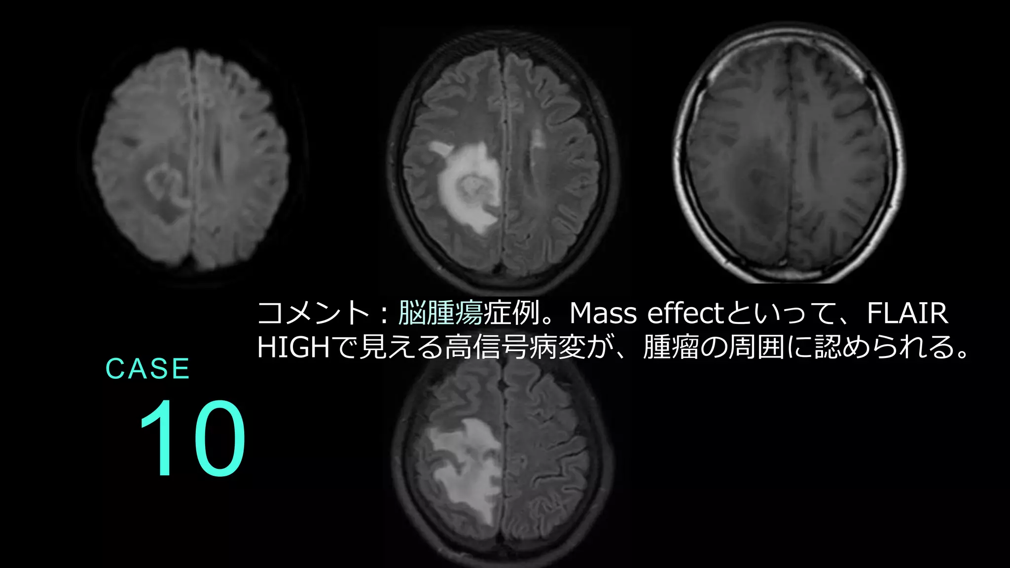 10
CASE
コメント：脳腫瘍症例。Mass effectといって、FLAIR
HIGHで見える高信号病変が、腫瘤の周囲に認められる。
 