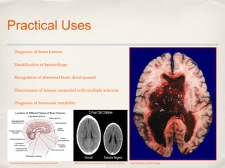 Practical Uses
Diagnosis of brain tumors
Identification of hemorrhage
Recognition of abnormal brain development
Discernment of lesions connected with multiple sclerosis
Diagnosis of hormonal instability

Possible locations for malignant brain tumors

Abnormal brain development in young children

Identification of hemorrhage

 