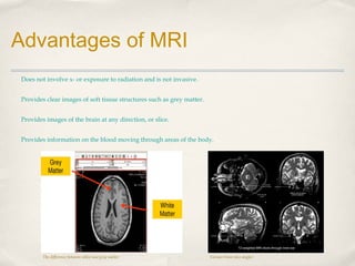 Advantages of MRI
Does not involve x- or exposure to radiation and is not invasive.
Provides clear images of soft tissue structures such as grey matter.
Provides images of the brain at any direction, or slice.
Provides information on the blood moving through areas of the body.

The difference between white and grey matter

Various brain slice angles

 