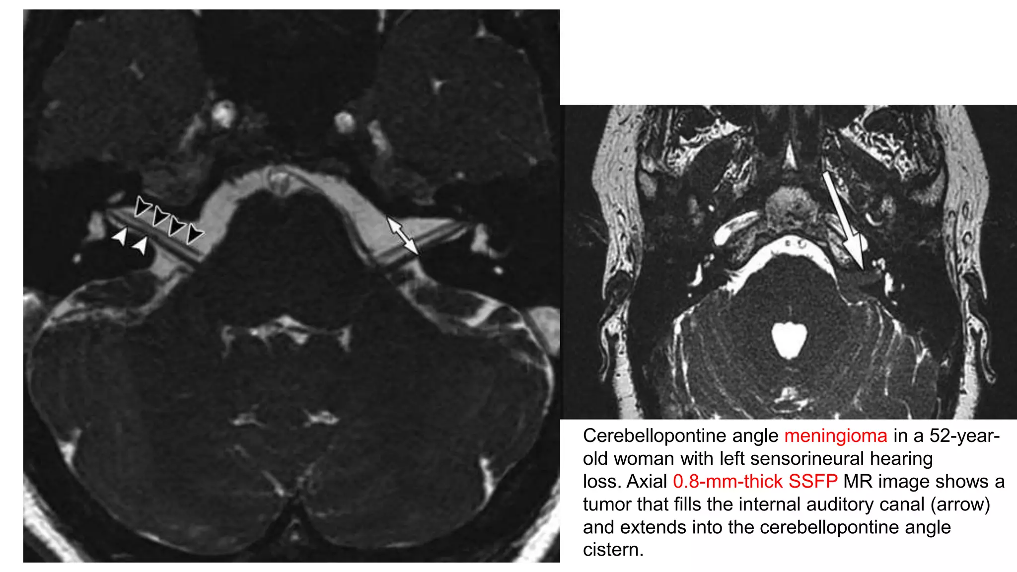 Cerebellopontine angle meningioma in a 52-year-
old woman with left sensorineural hearing
loss. Axial 0.8-mm-thick SSFP MR image shows a
tumor that fills the internal auditory canal (arrow)
and extends into the cerebellopontine angle
cistern.
 