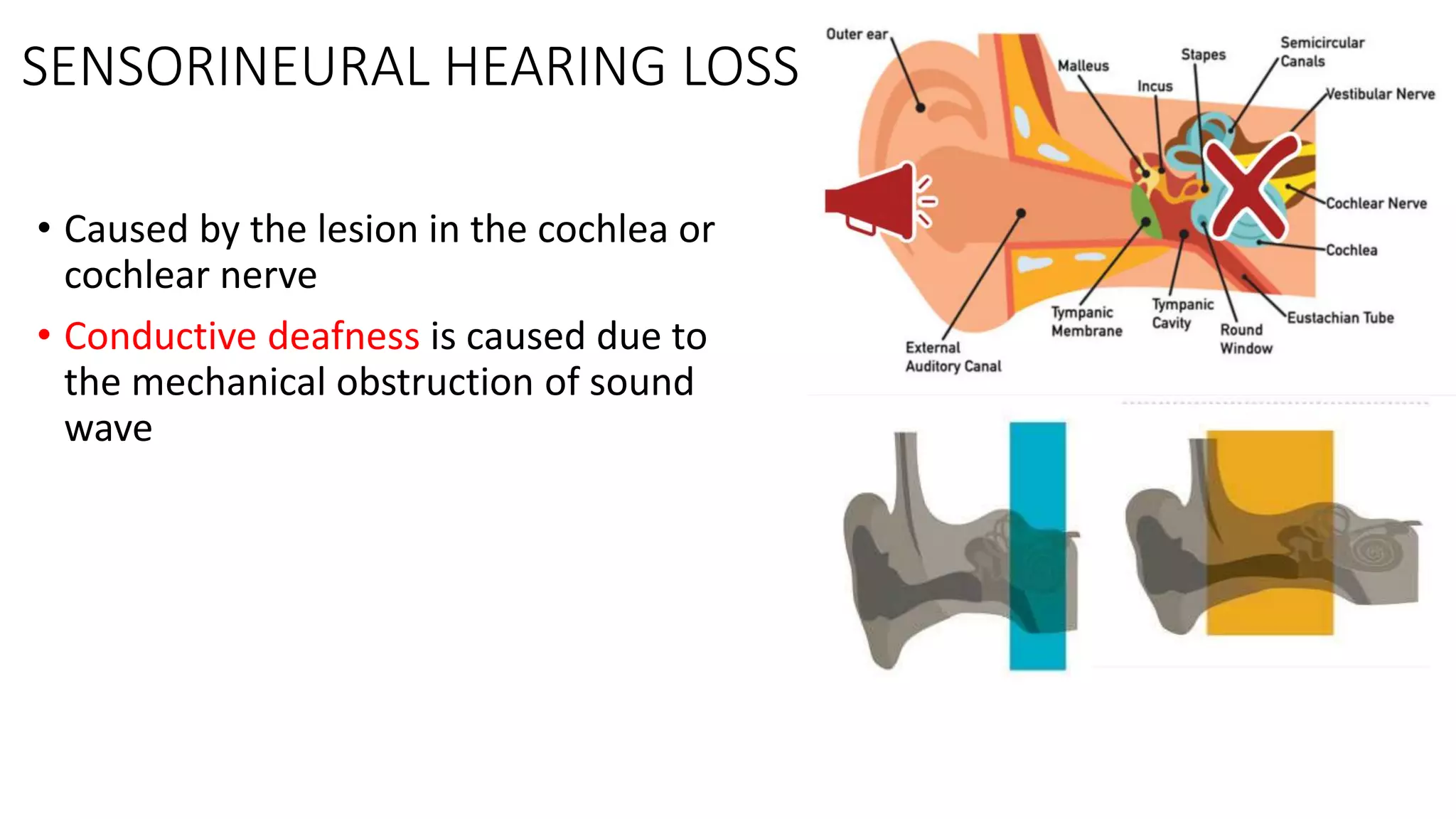 SENSORINEURAL HEARING LOSS
• Caused by the lesion in the cochlea or
cochlear nerve
• Conductive deafness is caused due to
the mechanical obstruction of sound
wave
 