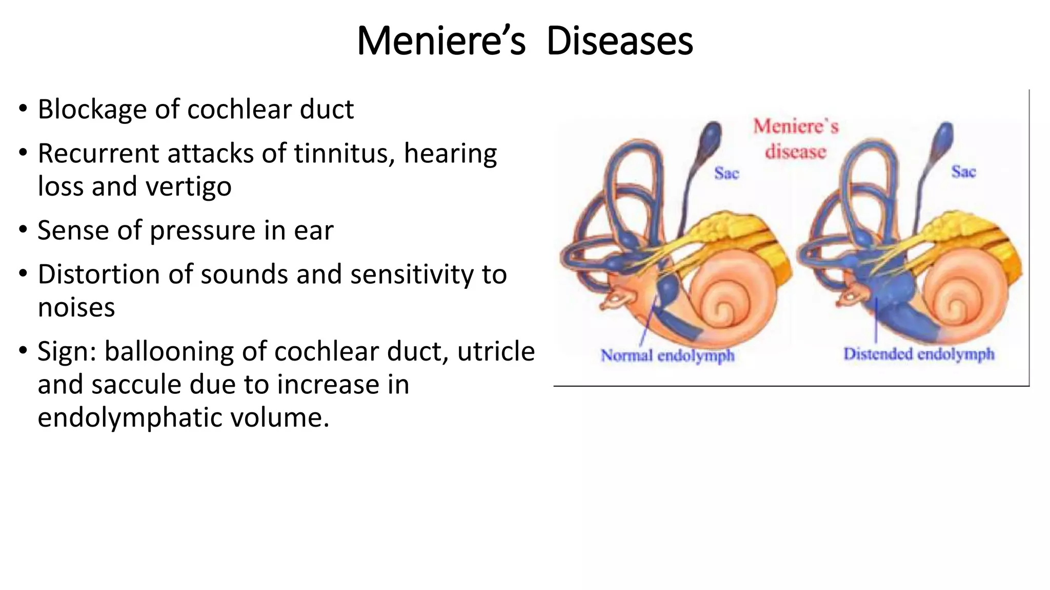 Meniere’s Diseases
• Blockage of cochlear duct
• Recurrent attacks of tinnitus, hearing
loss and vertigo
• Sense of pressure in ear
• Distortion of sounds and sensitivity to
noises
• Sign: ballooning of cochlear duct, utricle
and saccule due to increase in
endolymphatic volume.
 