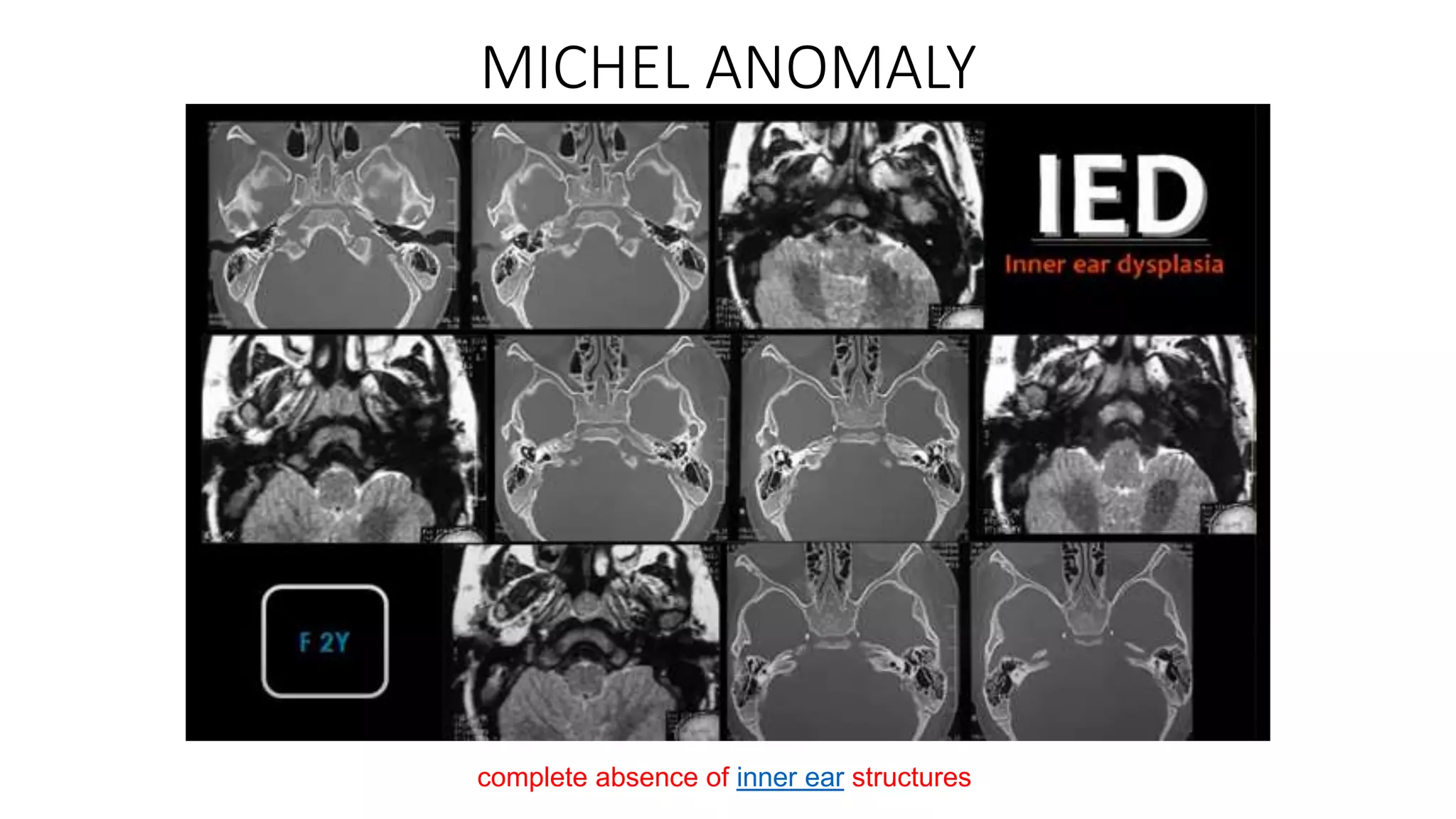 MICHEL ANOMALY
complete absence of inner ear structures
 
