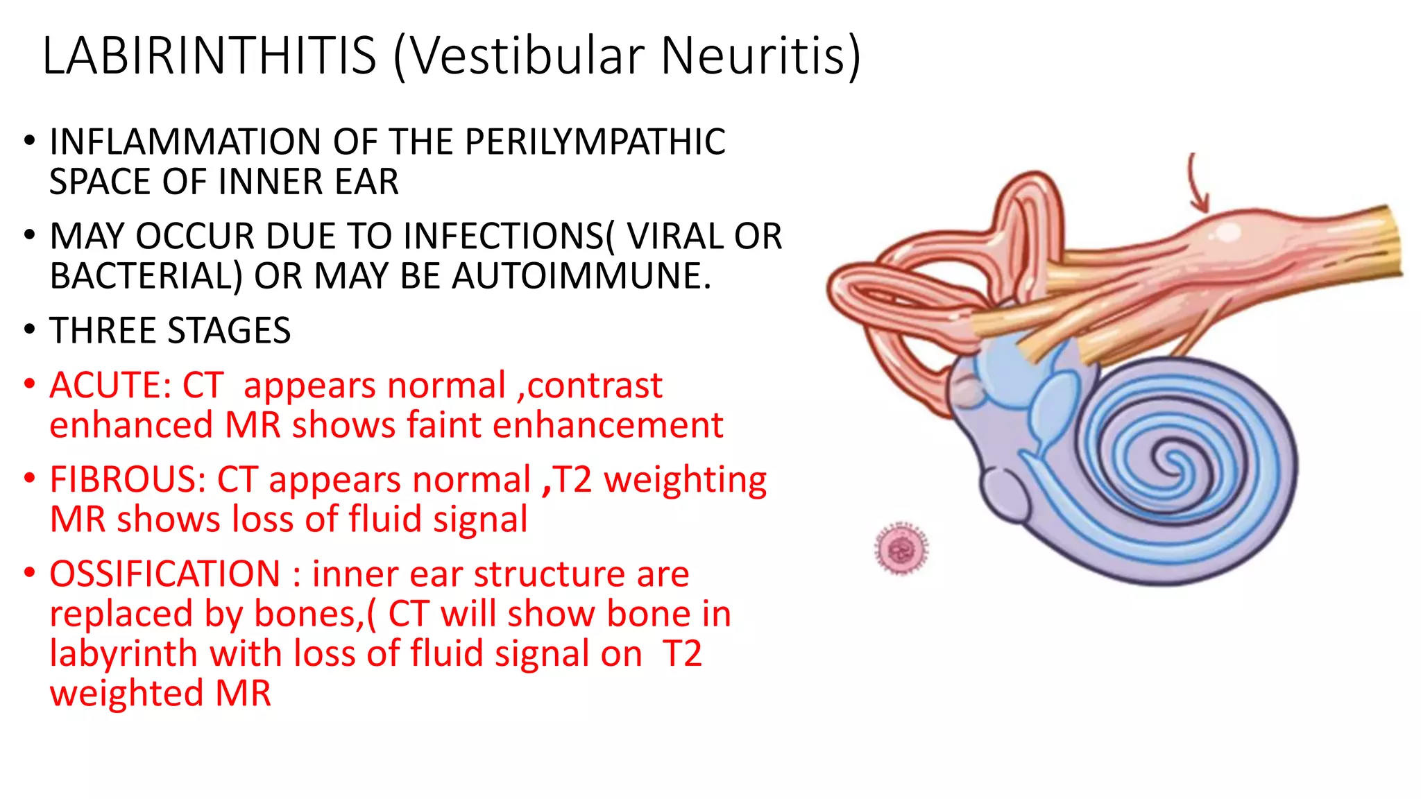 LABIRINTHITIS (Vestibular Neuritis)
• INFLAMMATION OF THE PERILYMPATHIC
SPACE OF INNER EAR
• MAY OCCUR DUE TO INFECTIONS( VIRAL OR
BACTERIAL) OR MAY BE AUTOIMMUNE.
• THREE STAGES
• ACUTE: CT appears normal ,contrast
enhanced MR shows faint enhancement
• FIBROUS: CT appears normal ,T2 weighting
MR shows loss of fluid signal
• OSSIFICATION : inner ear structure are
replaced by bones,( CT will show bone in
labyrinth with loss of fluid signal on T2
weighted MR
 