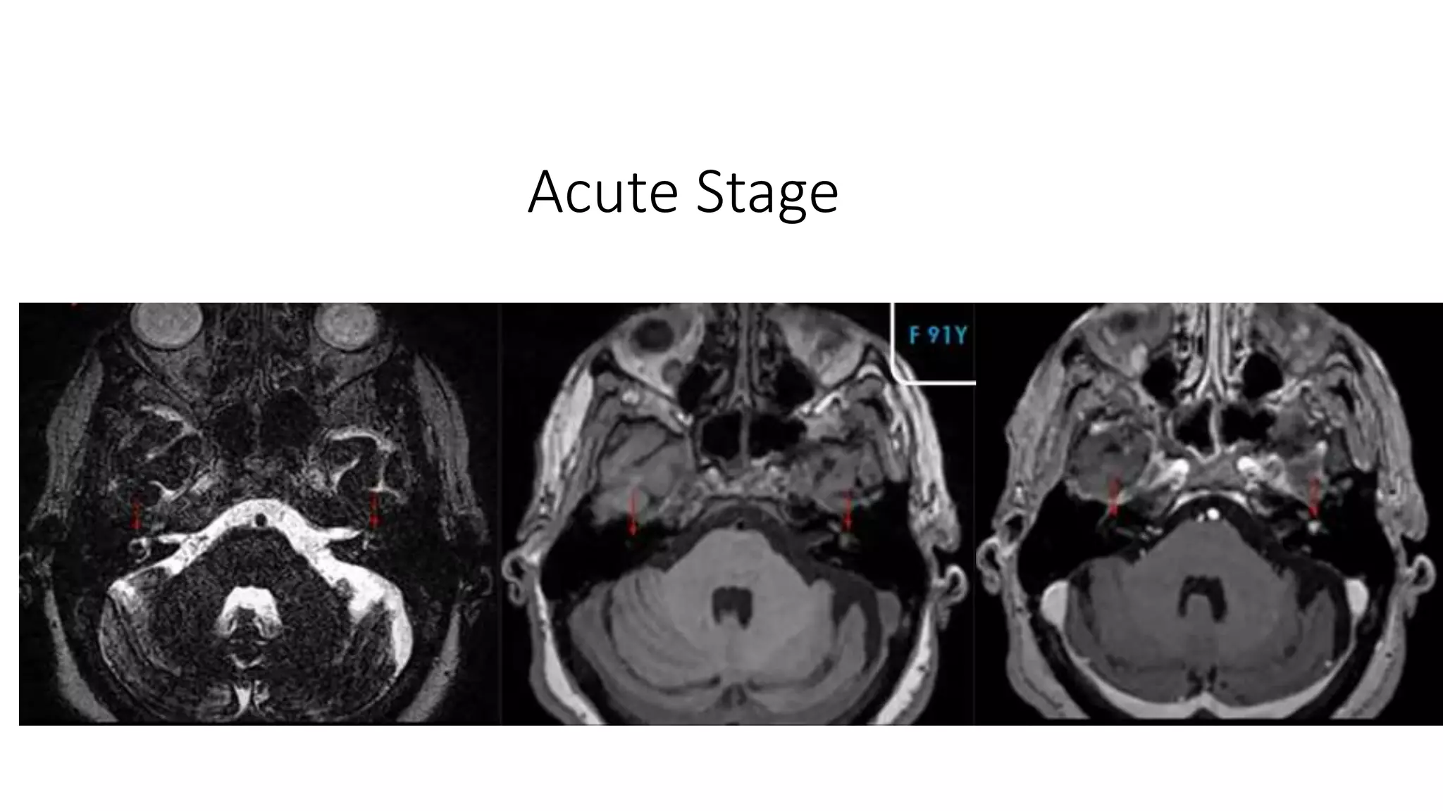 Acute Stage
 