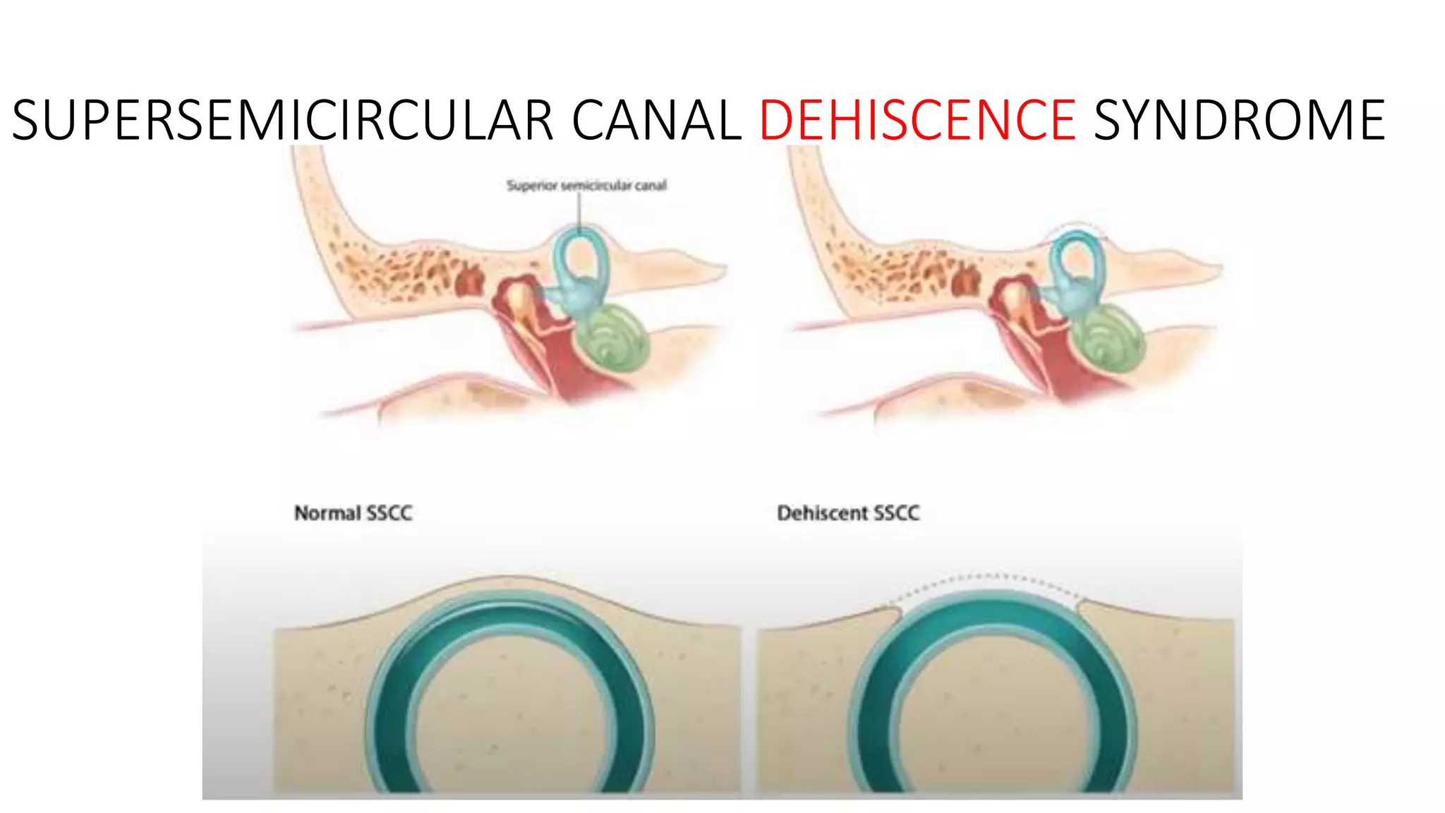 SUPERSEMICIRCULAR CANAL DEHISCENCE SYNDROME
 