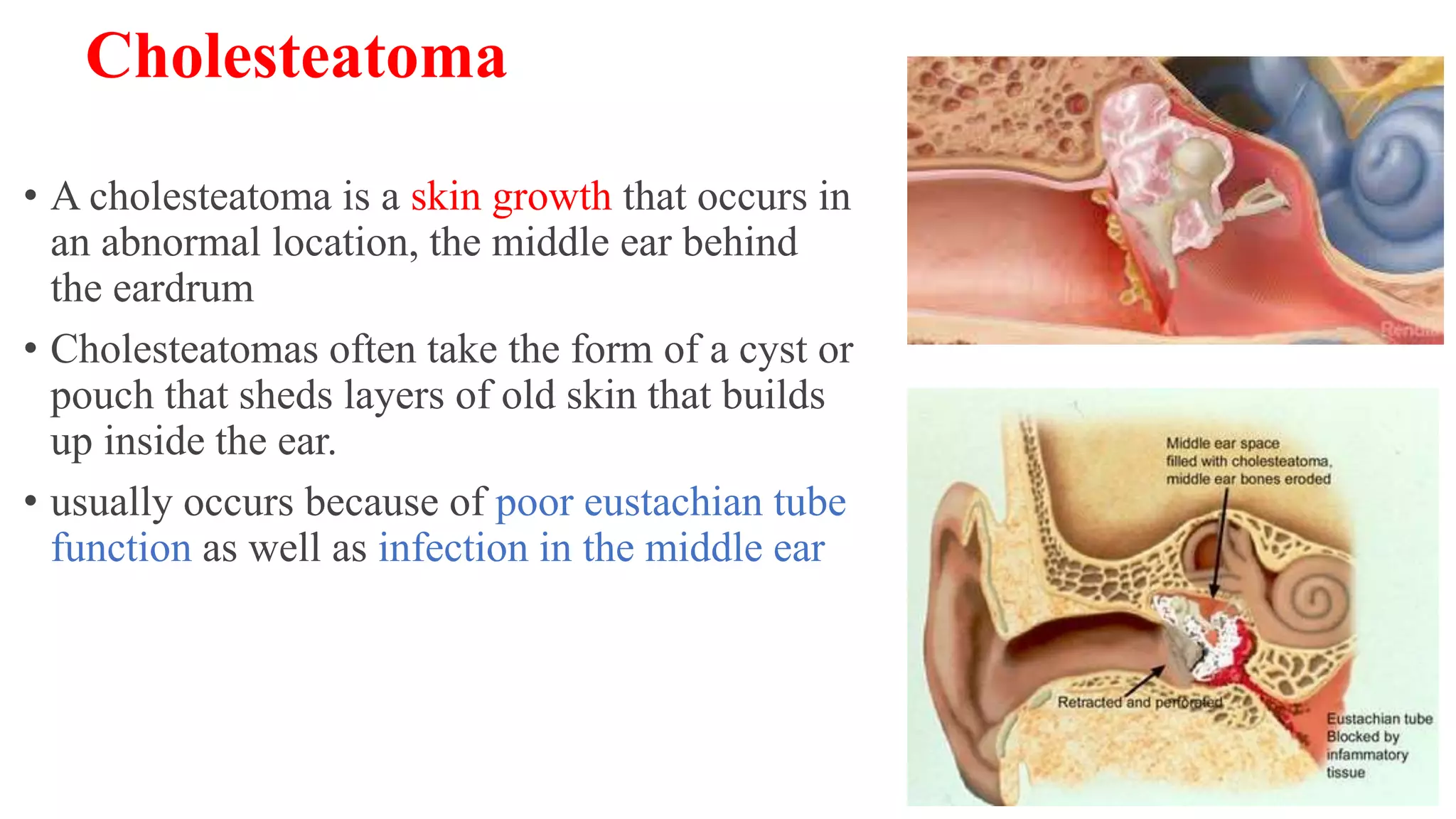 Cholesteatoma
• A cholesteatoma is a skin growth that occurs in
an abnormal location, the middle ear behind
the eardrum
• Cholesteatomas often take the form of a cyst or
pouch that sheds layers of old skin that builds
up inside the ear.
• usually occurs because of poor eustachian tube
function as well as infection in the middle ear
 