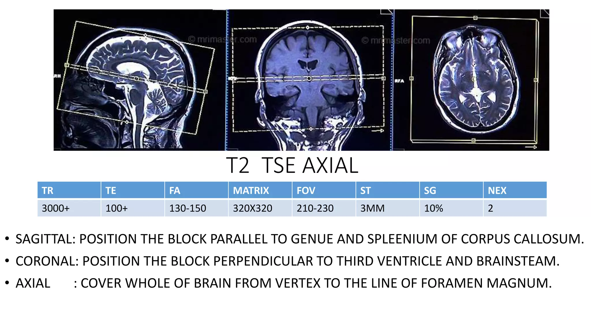 T2 TSE AXIAL
• SAGITTAL: POSITION THE BLOCK PARALLEL TO GENUE AND SPLEENIUM OF CORPUS CALLOSUM.
• CORONAL: POSITION THE BLOCK PERPENDICULAR TO THIRD VENTRICLE AND BRAINSTEAM.
• AXIAL : COVER WHOLE OF BRAIN FROM VERTEX TO THE LINE OF FORAMEN MAGNUM.
TR TE FA MATRIX FOV ST SG NEX
3000+ 100+ 130-150 320X320 210-230 3MM 10% 2
 
