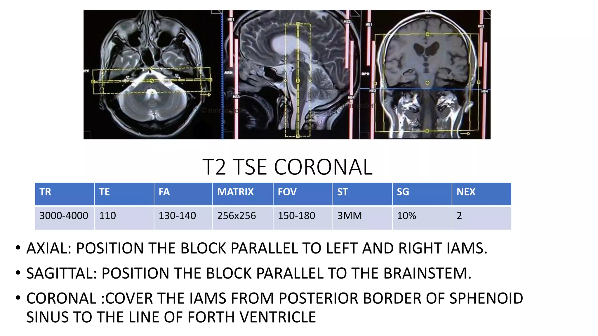 T2 TSE CORONAL
• AXIAL: POSITION THE BLOCK PARALLEL TO LEFT AND RIGHT IAMS.
• SAGITTAL: POSITION THE BLOCK PARALLEL TO THE BRAINSTEM.
• CORONAL :COVER THE IAMS FROM POSTERIOR BORDER OF SPHENOID
SINUS TO THE LINE OF FORTH VENTRICLE
TR TE FA MATRIX FOV ST SG NEX
3000-4000 110 130-140 256x256 150-180 3MM 10% 2
 
