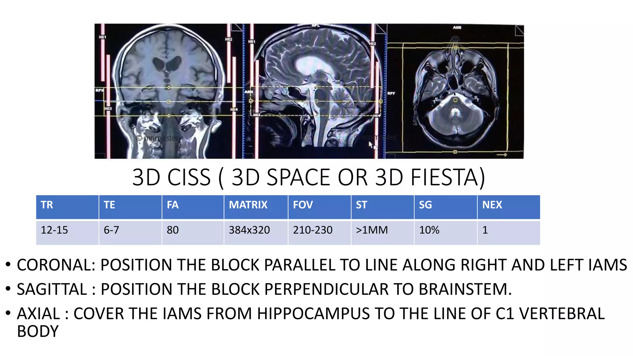 3D CISS ( 3D SPACE OR 3D FIESTA)
• CORONAL: POSITION THE BLOCK PARALLEL TO LINE ALONG RIGHT AND LEFT IAMS
• SAGITTAL : POSITION THE BLOCK PERPENDICULAR TO BRAINSTEM.
• AXIAL : COVER THE IAMS FROM HIPPOCAMPUS TO THE LINE OF C1 VERTEBRAL
BODY
TR TE FA MATRIX FOV ST SG NEX
12-15 6-7 80 384x320 210-230 >1MM 10% 1
 