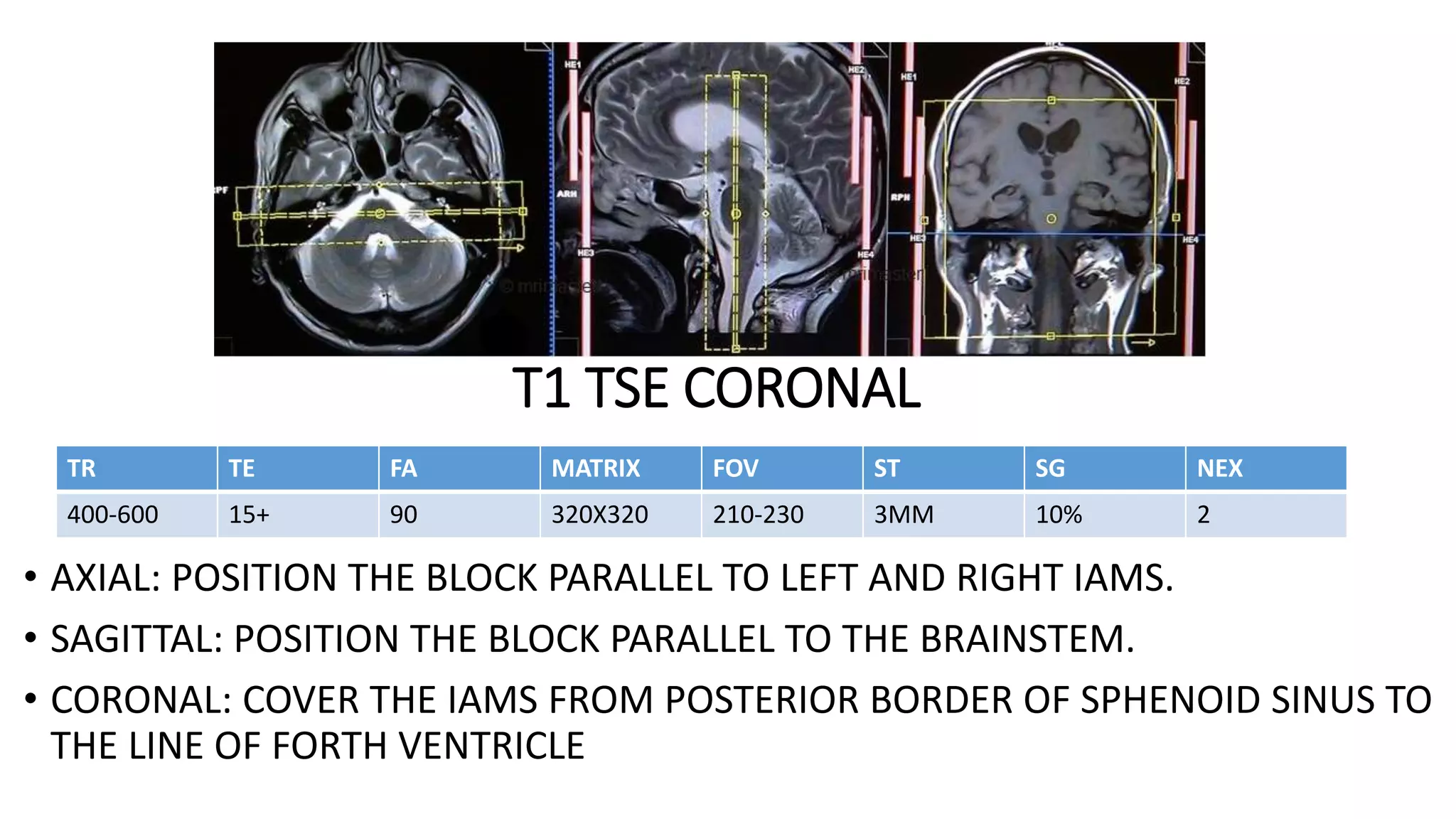 T1 TSE CORONAL
• AXIAL: POSITION THE BLOCK PARALLEL TO LEFT AND RIGHT IAMS.
• SAGITTAL: POSITION THE BLOCK PARALLEL TO THE BRAINSTEM.
• CORONAL: COVER THE IAMS FROM POSTERIOR BORDER OF SPHENOID SINUS TO
THE LINE OF FORTH VENTRICLE
TR TE FA MATRIX FOV ST SG NEX
400-600 15+ 90 320X320 210-230 3MM 10% 2
 