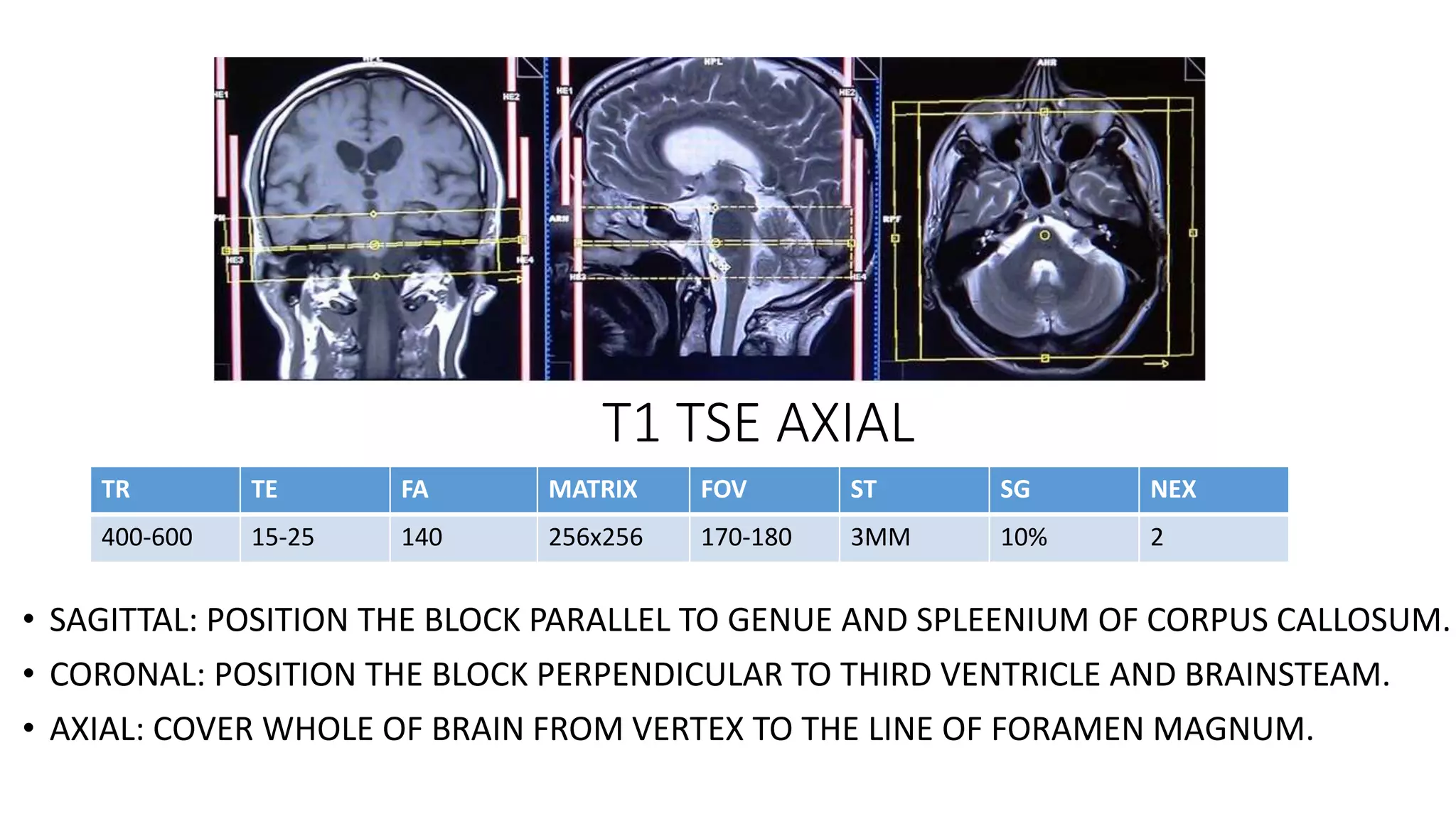 T1 TSE AXIAL
• SAGITTAL: POSITION THE BLOCK PARALLEL TO GENUE AND SPLEENIUM OF CORPUS CALLOSUM.
• CORONAL: POSITION THE BLOCK PERPENDICULAR TO THIRD VENTRICLE AND BRAINSTEAM.
• AXIAL: COVER WHOLE OF BRAIN FROM VERTEX TO THE LINE OF FORAMEN MAGNUM.
TR TE FA MATRIX FOV ST SG NEX
400-600 15-25 140 256x256 170-180 3MM 10% 2
 