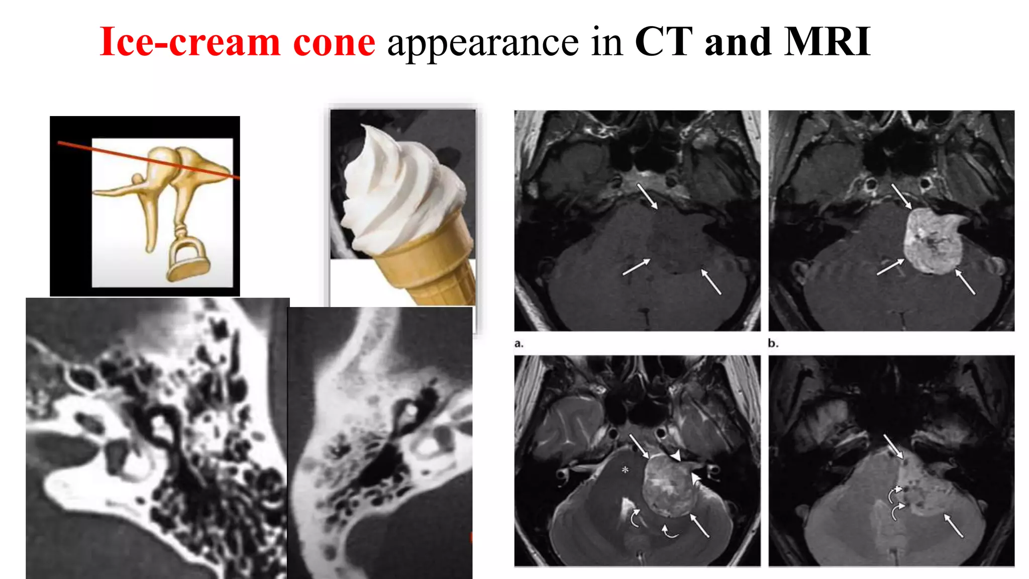 Ice-cream cone appearance in CT and MRI
 