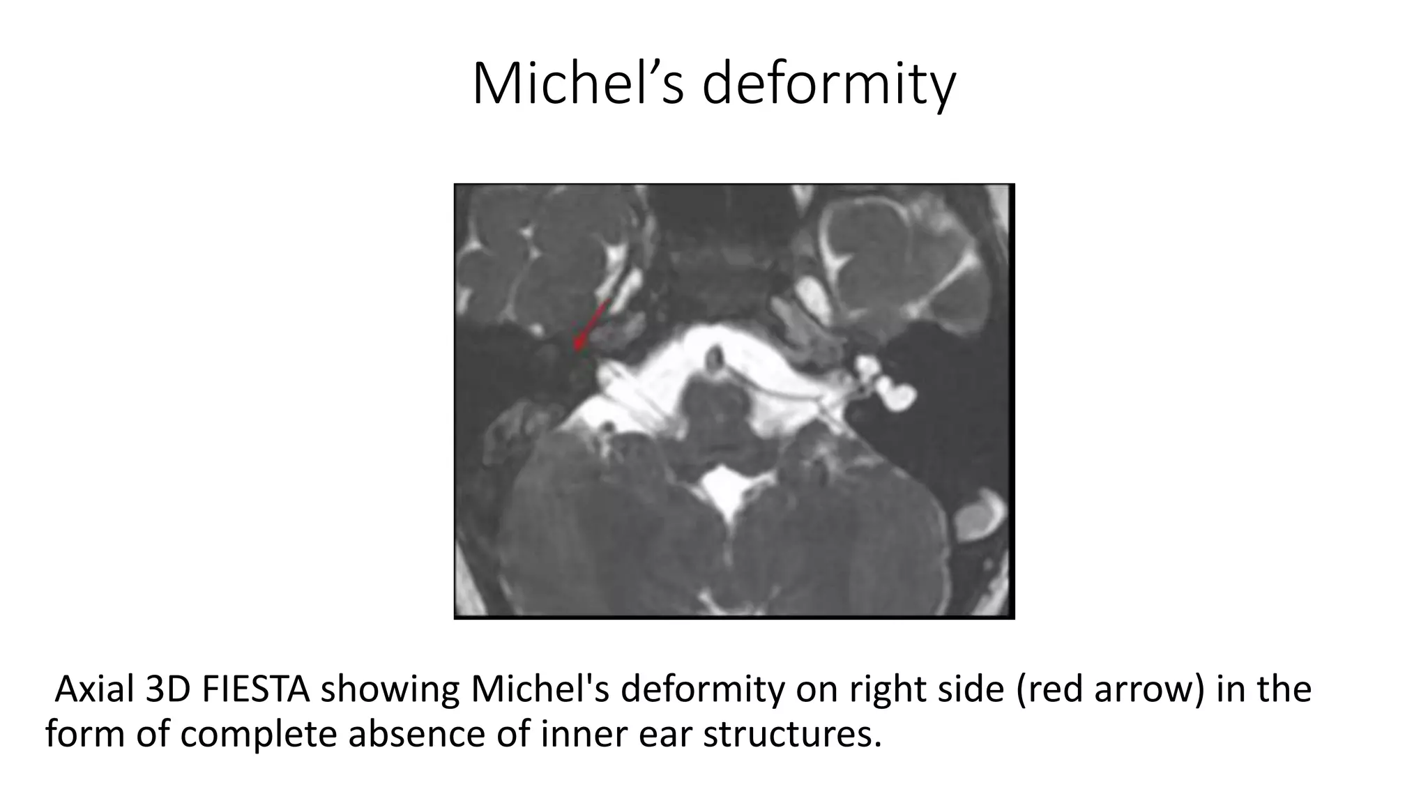 Michel’s deformity
Axial 3D FIESTA showing Michel's deformity on right side (red arrow) in the
form of complete absence of inner ear structures.
 