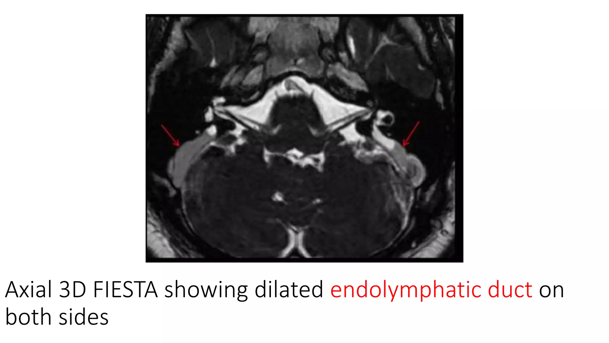 Axial 3D FIESTA showing dilated endolymphatic duct on
both sides
 