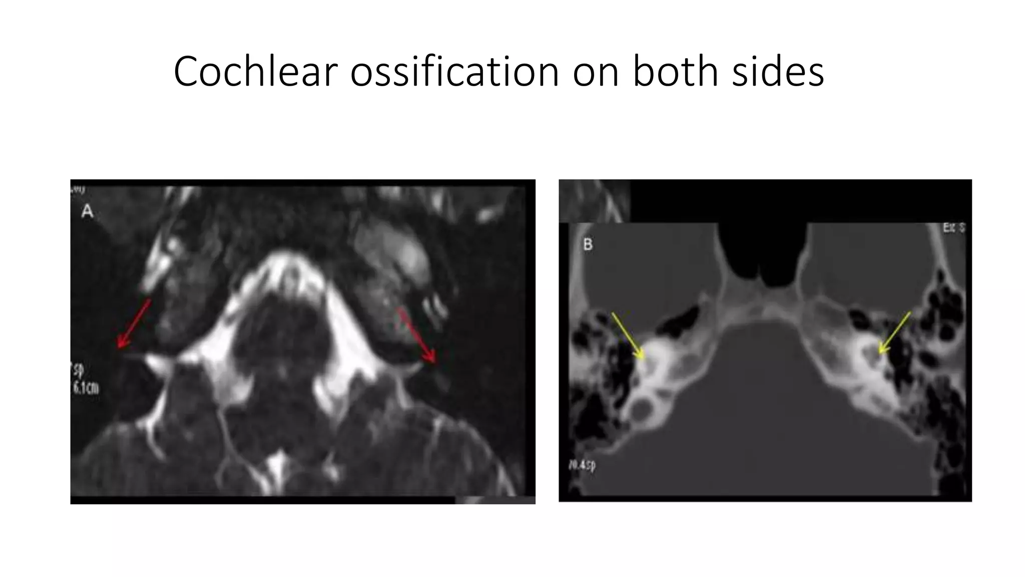 Cochlear ossification on both sides
 