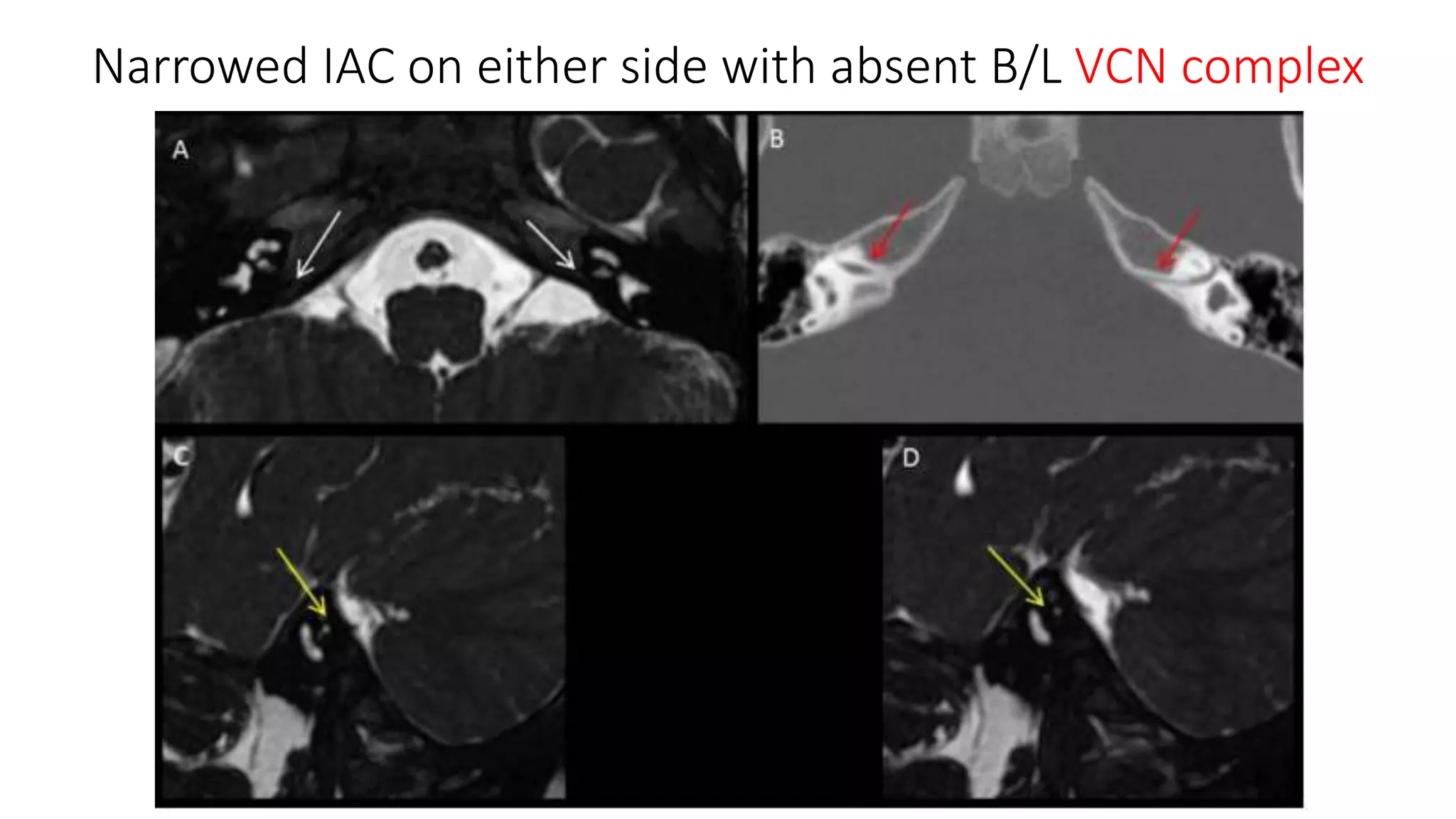 Narrowed IAC on either side with absent B/L VCN complex
 