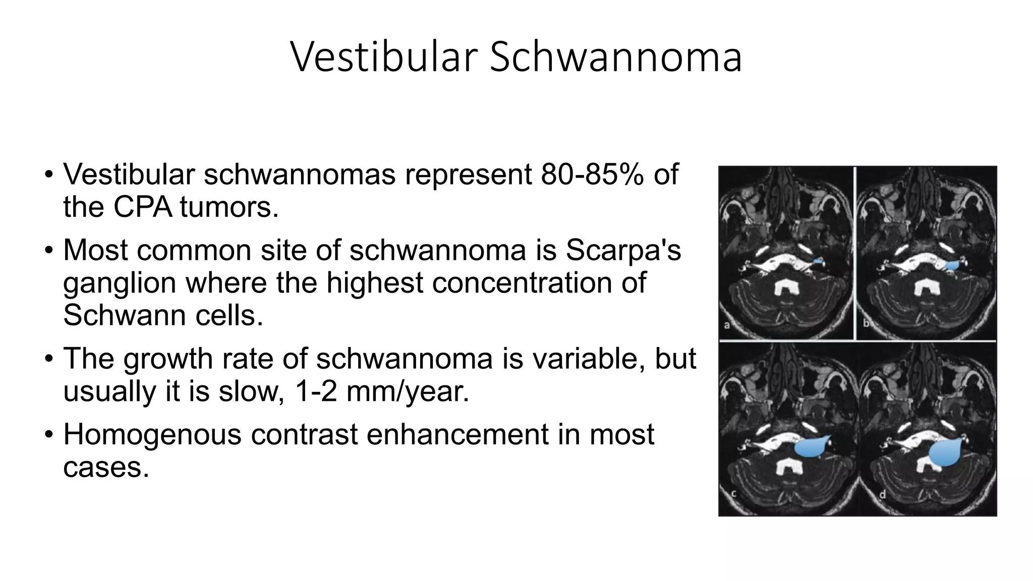 Vestibular Schwannoma
• Vestibular schwannomas represent 80-85% of
the CPA tumors.
• Most common site of schwannoma is Scarpa's
ganglion where the highest concentration of
Schwann cells.
• The growth rate of schwannoma is variable, but
usually it is slow, 1-2 mm/year.
• Homogenous contrast enhancement in most
cases.
 