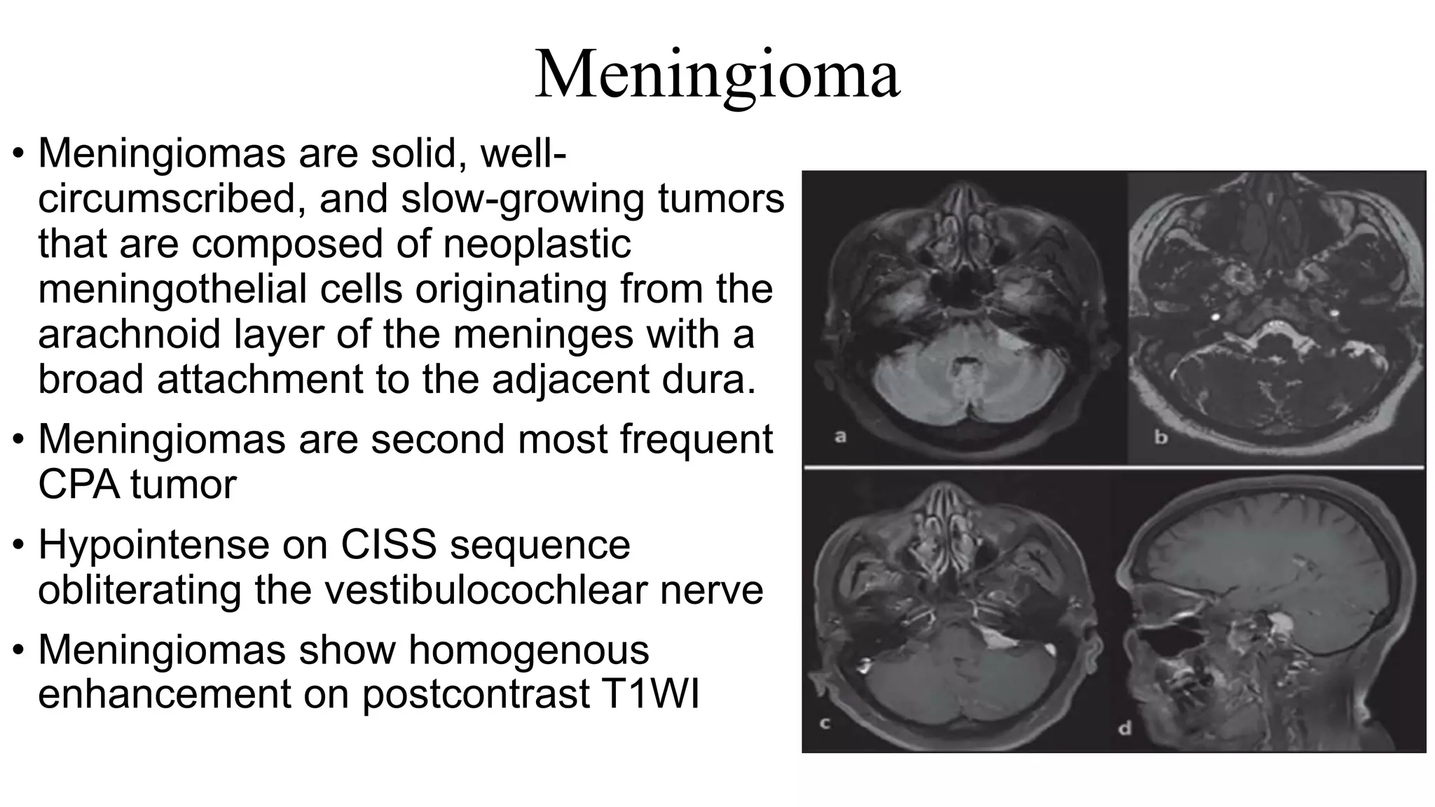 Meningioma
• Meningiomas are solid, well-
circumscribed, and slow-growing tumors
that are composed of neoplastic
meningothelial cells originating from the
arachnoid layer of the meninges with a
broad attachment to the adjacent dura.
• Meningiomas are second most frequent
CPA tumor
• Hypointense on CISS sequence
obliterating the vestibulocochlear nerve
• Meningiomas show homogenous
enhancement on postcontrast T1WI
 