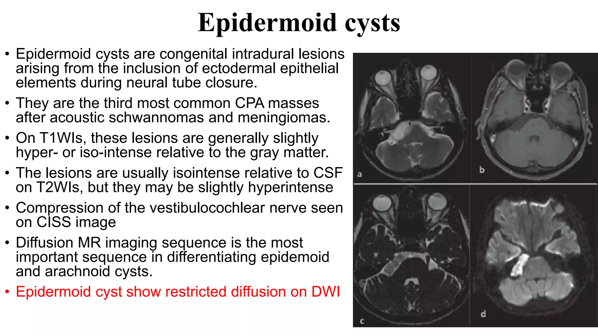 Epidermoid cysts
• Epidermoid cysts are congenital intradural lesions
arising from the inclusion of ectodermal epithelial
elements during neural tube closure.
• They are the third most common CPA masses
after acoustic schwannomas and meningiomas.
• On T1WIs, these lesions are generally slightly
hyper- or iso-intense relative to the gray matter.
• The lesions are usually isointense relative to CSF
on T2WIs, but they may be slightly hyperintense
• Compression of the vestibulocochlear nerve seen
on CISS image
• Diffusion MR imaging sequence is the most
important sequence in differentiating epidemoid
and arachnoid cysts.
• Epidermoid cyst show restricted diffusion on DWI
 