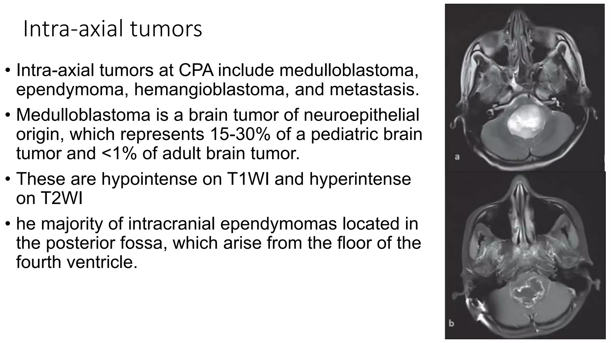 Intra-axial tumors
• Intra-axial tumors at CPA include medulloblastoma,
ependymoma, hemangioblastoma, and metastasis.
• Medulloblastoma is a brain tumor of neuroepithelial
origin, which represents 15-30% of a pediatric brain
tumor and <1% of adult brain tumor.
• These are hypointense on T1WI and hyperintense
on T2WI
• he majority of intracranial ependymomas located in
the posterior fossa, which arise from the floor of the
fourth ventricle.
 