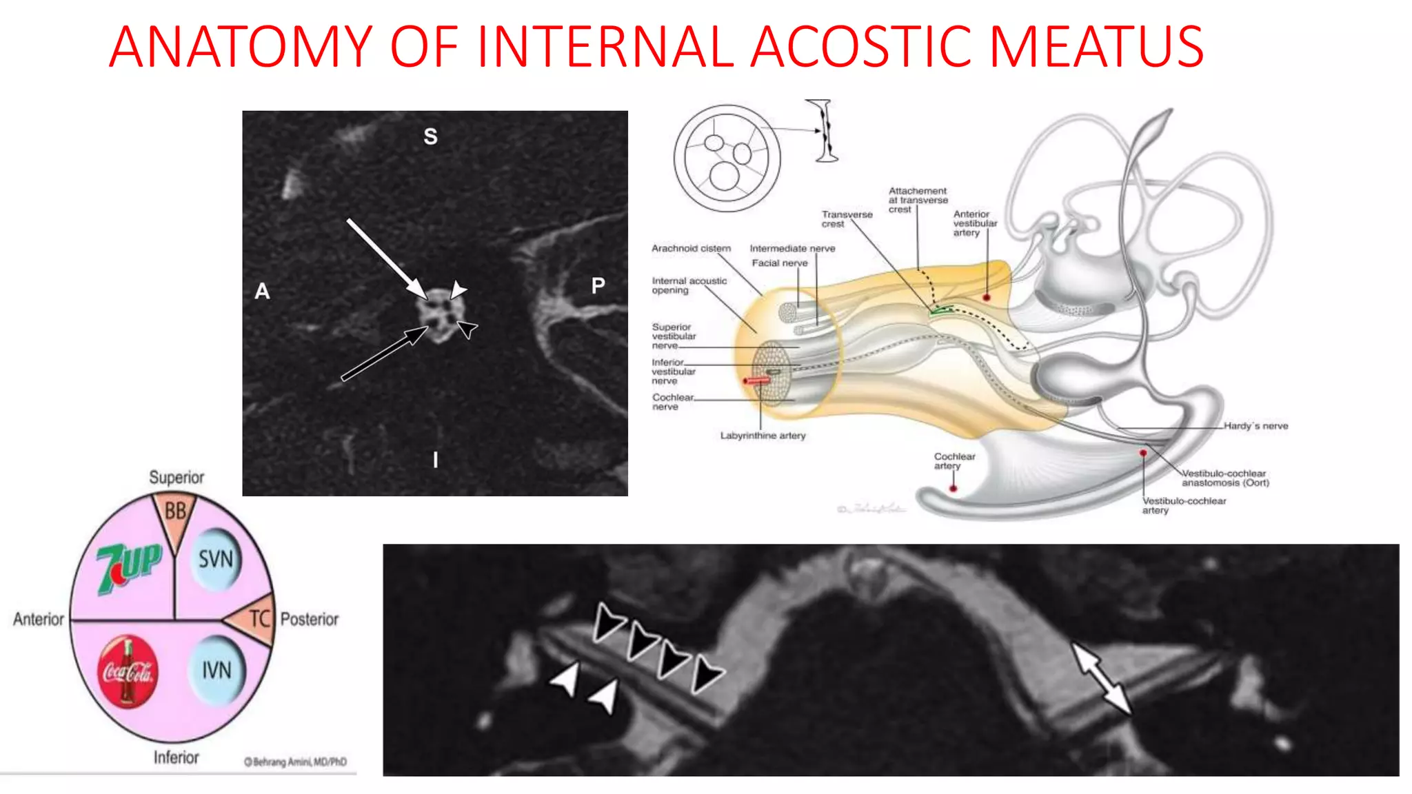 ANATOMY OF INTERNAL ACOSTIC MEATUS
 