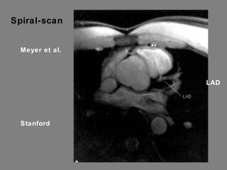 LAD Spiral-scan 512X512 surface coil 15 cm FOV acquired over 4 breath holds 80 spirals Zero TE FID image Meyer et al. Stanford 