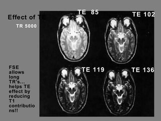 Effect of TE TR 5000 TE  85 TE 119 TE 136 TE 102 FSE allows long TR's... helps TE effect by reducing T1 contributions!! 