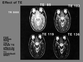 Effect of TE TR 5000 TE  85 TE 119 TE 136 TE 102 FSE allows long TR's... helps TE effect by reducing T1 contributions!! 