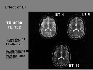 Effect of ET TR 4000 TE 102 ET 4 ET 16 ET 8 Increasing ET increases T2 effects... By increasing the contribution from the later echoes... 