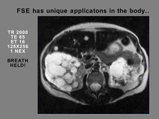 FSE has unique applicatons in the body.. TR 2000 TE 85 ET 16 128X256 1 NEX BREATH HELD! 