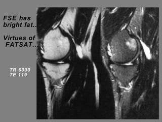 FSE has bright fat.. Virtues of FATSAT... TR 6000 TE 119  
