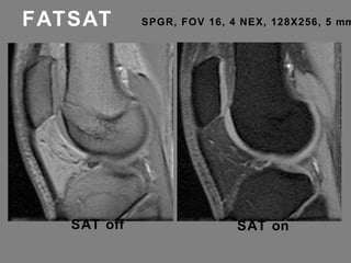FATSAT SPGR, FOV 16, 4 NEX, 128X256, 5 mm  SAT off SAT on 